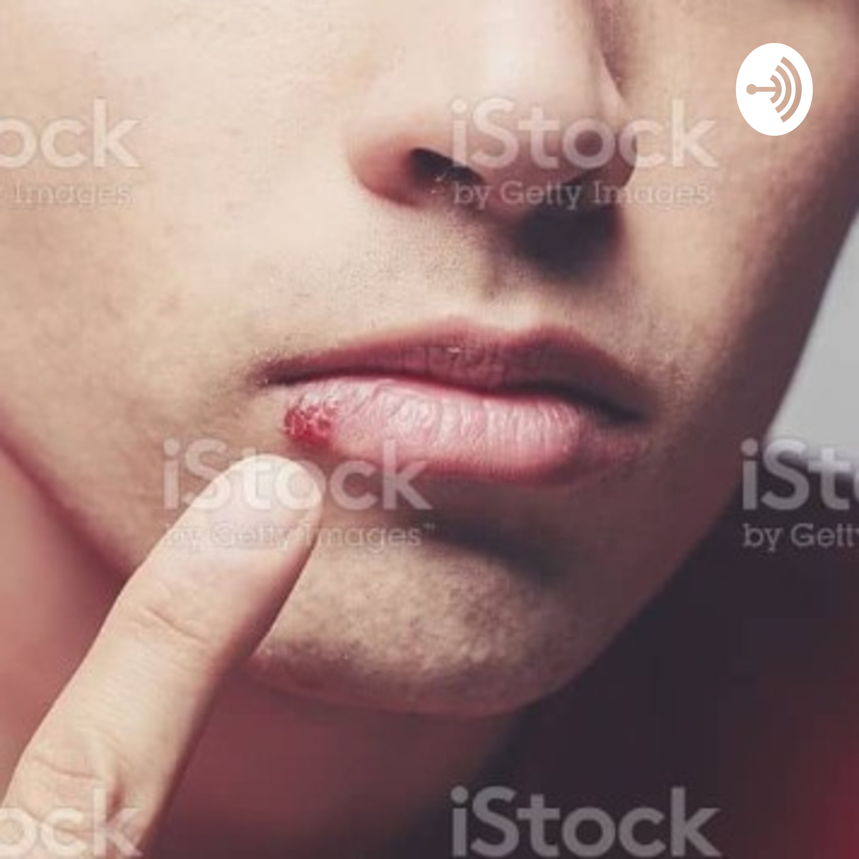 An Exposition On Cold sores by King Emmanuel