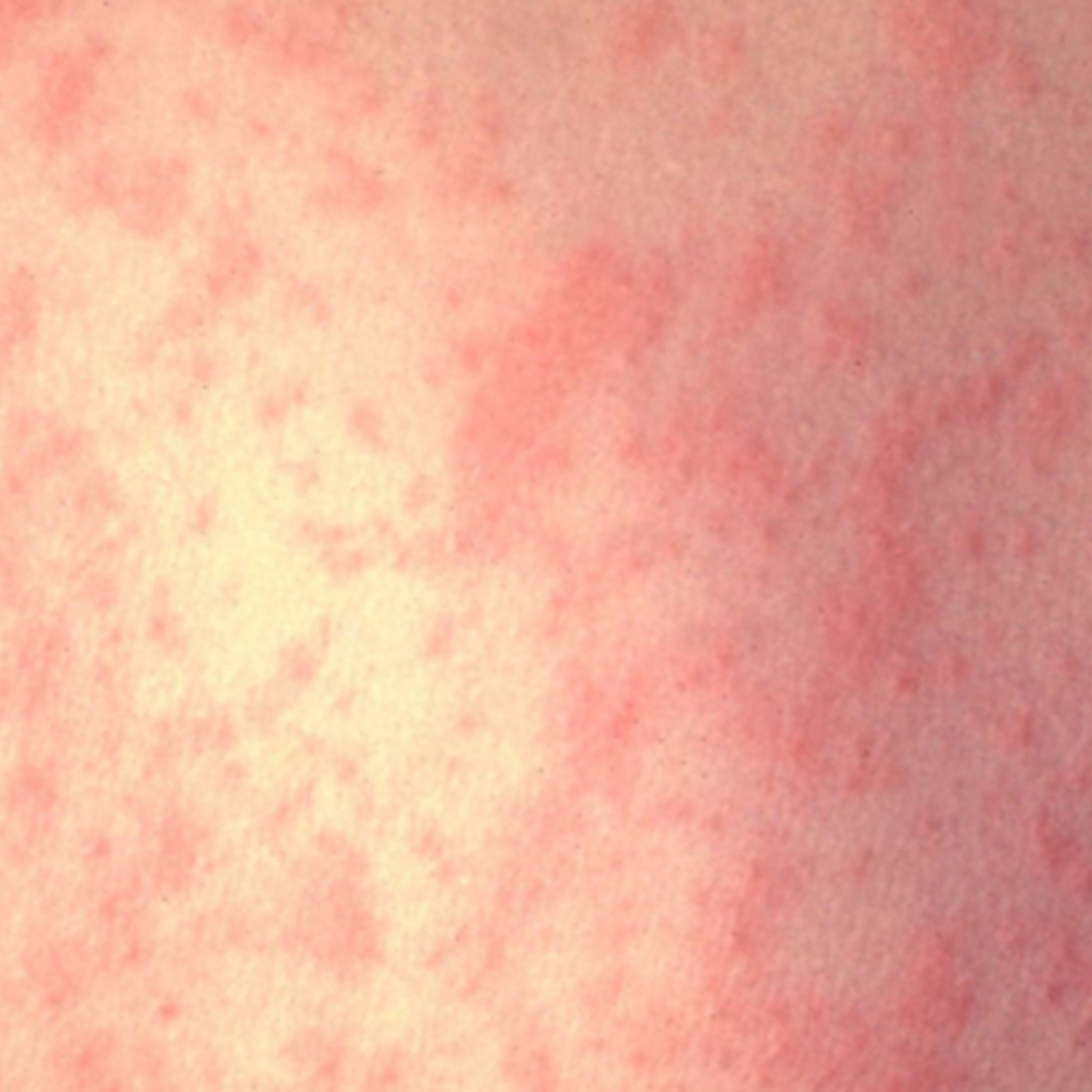 Measles podcast