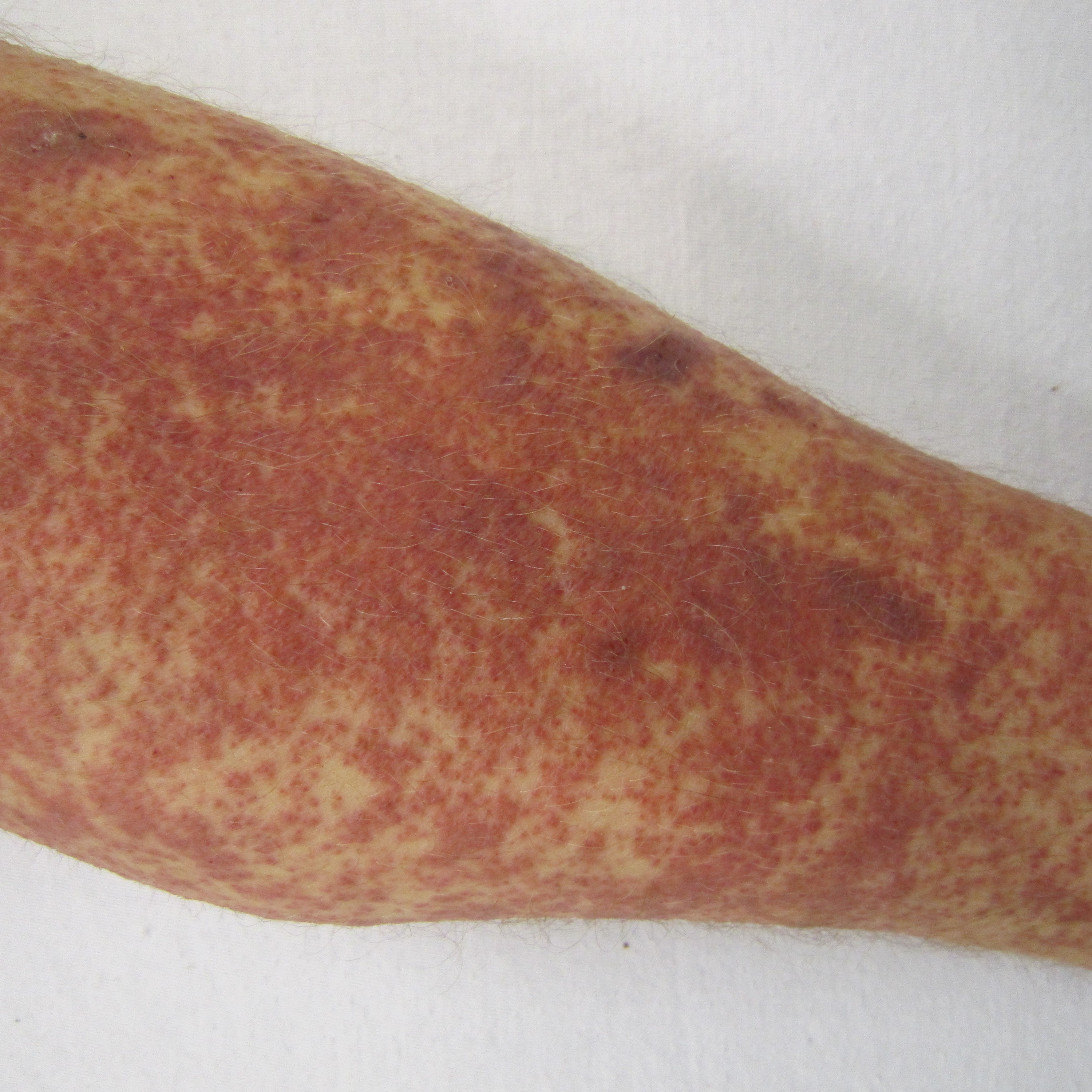 Reumatologia : Artritis reumatoidea y vasculitis