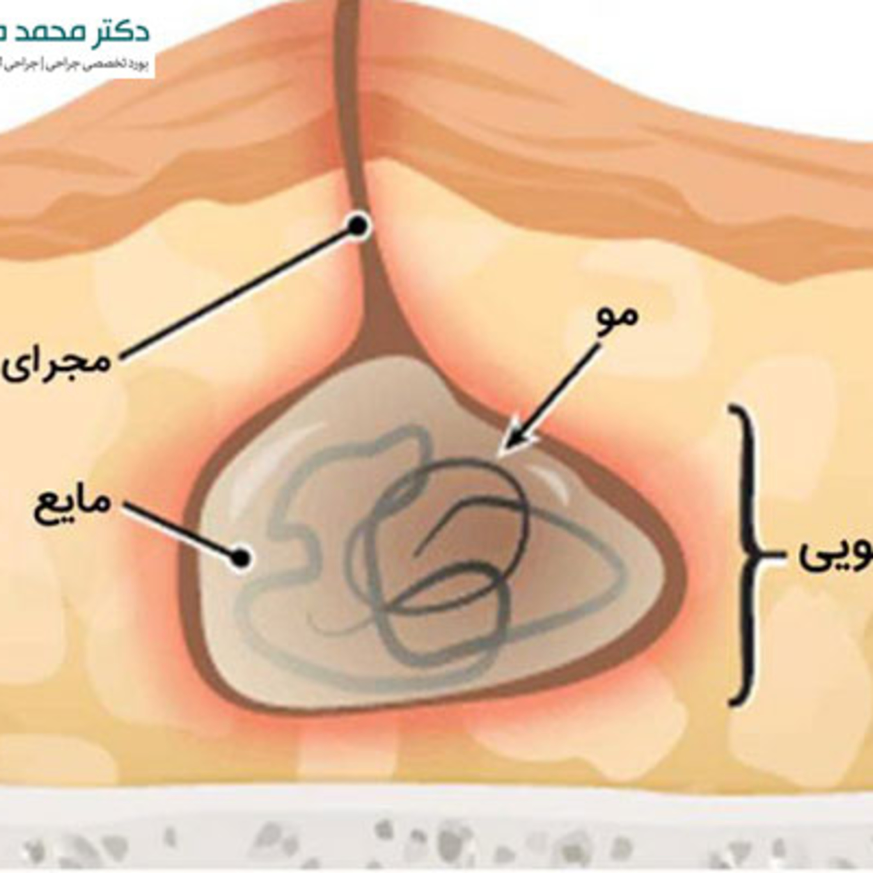 کاور کیست مویی چیست؟