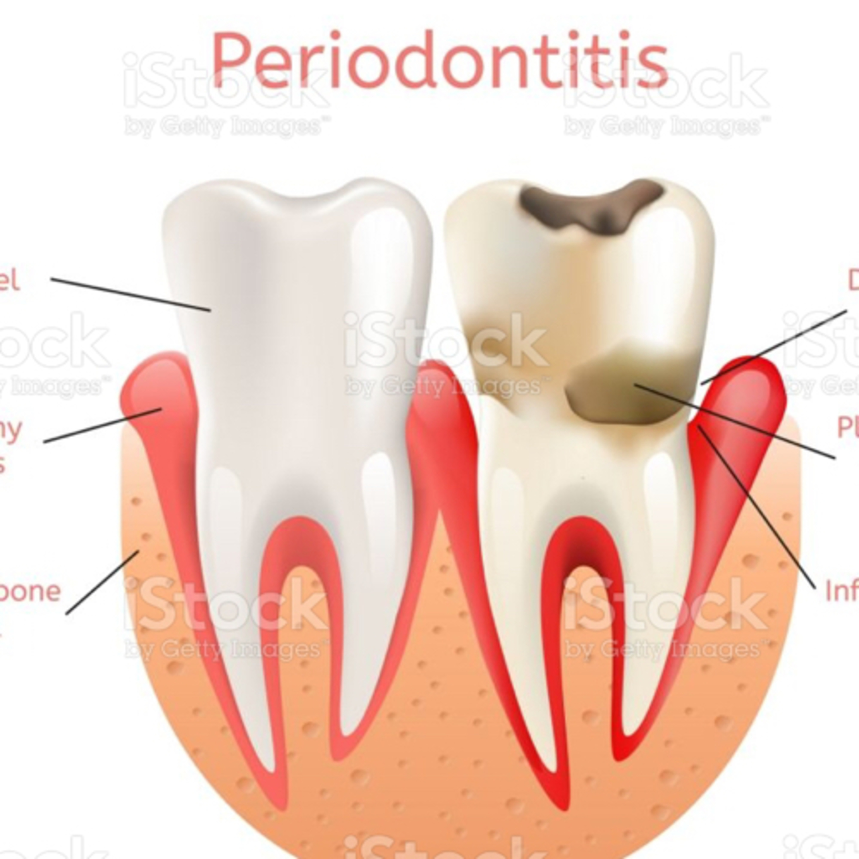 Periodontitis  episode artwork