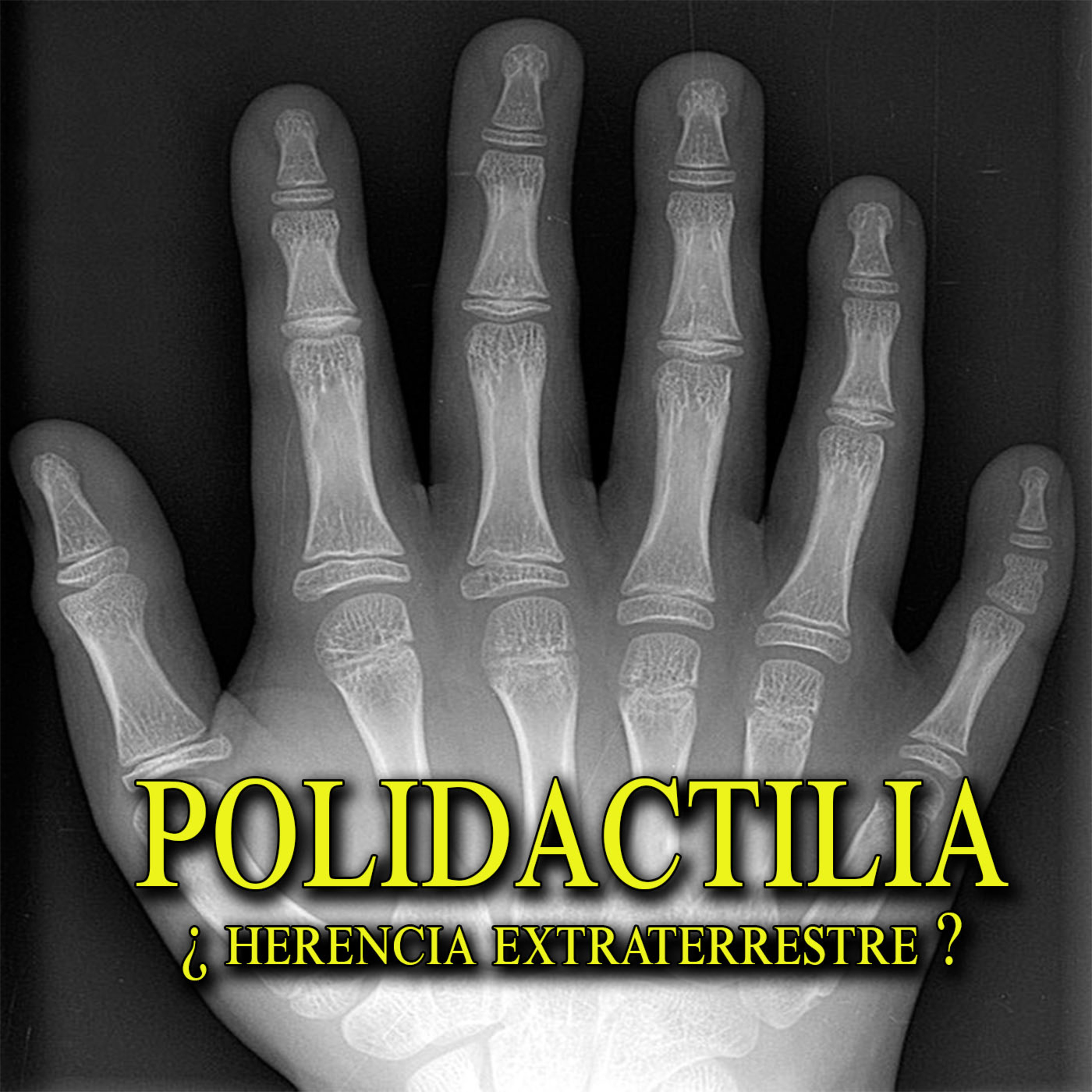 ¿Polidactilia Herencia Extraterrestre? Una rara condición de tener 6 dedos en pies y manos