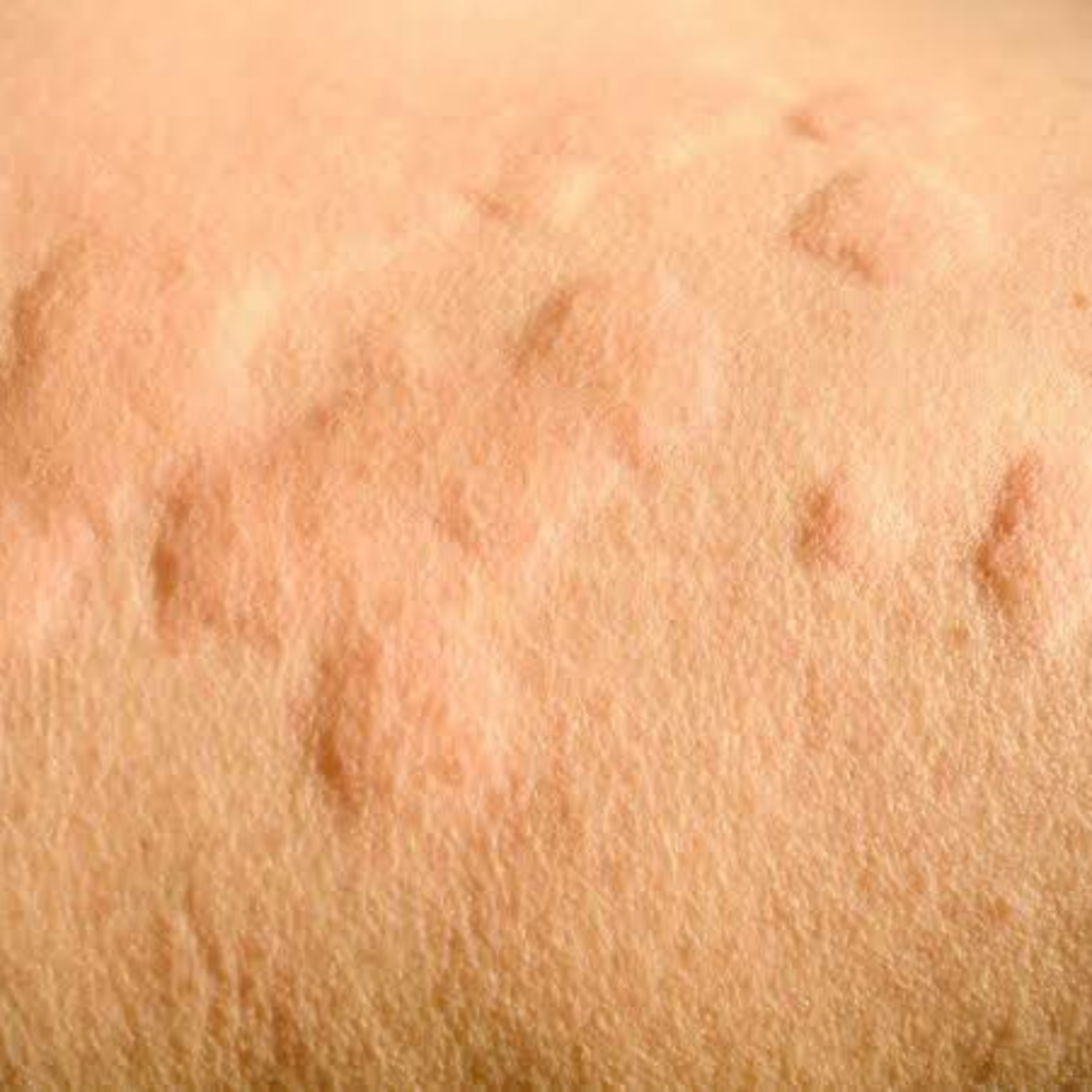 Mx of Acute contrast reaction (Hives/urticaria and diffuse erythema)