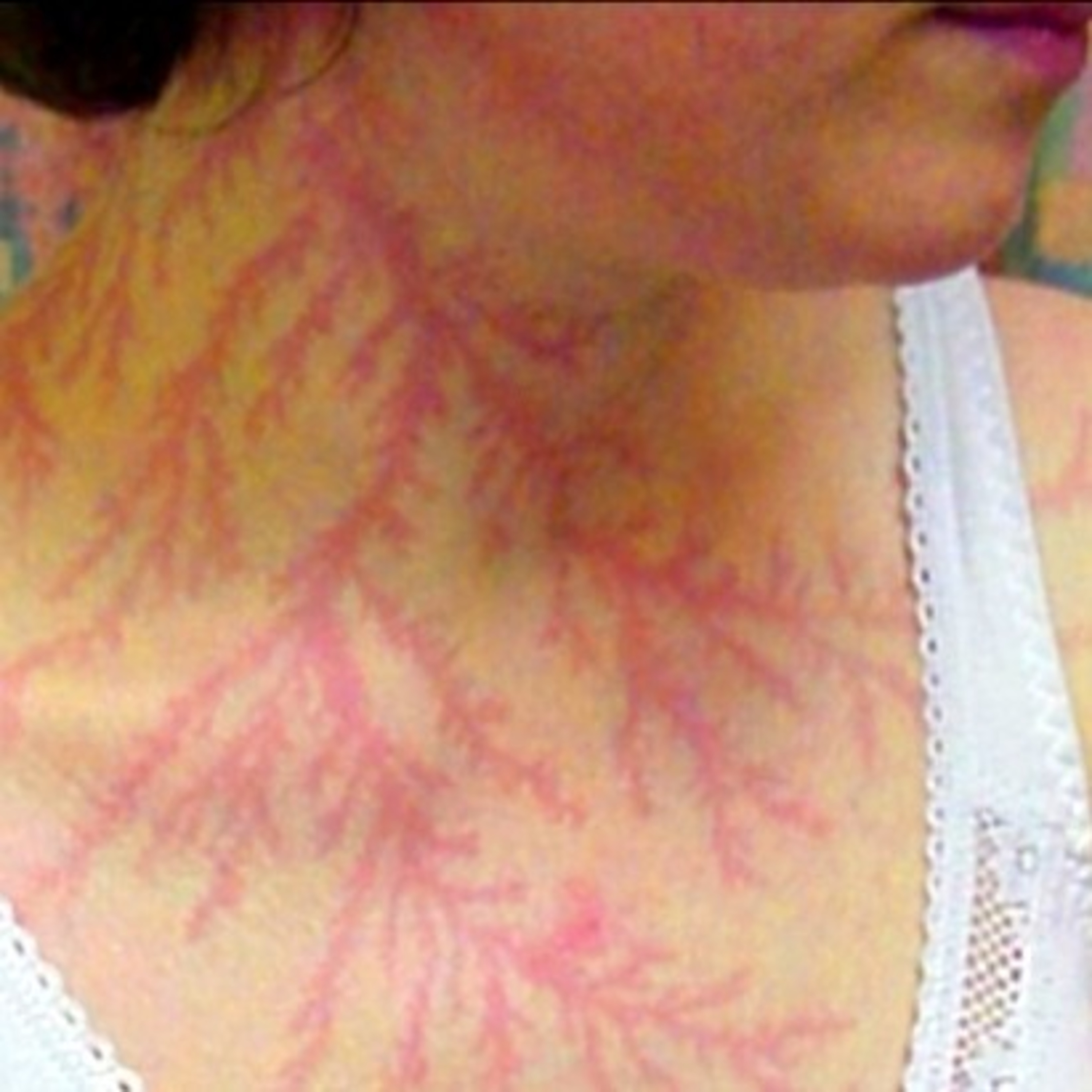 Here's what happens to your skin when you survive being struck by lightning  episode artwork