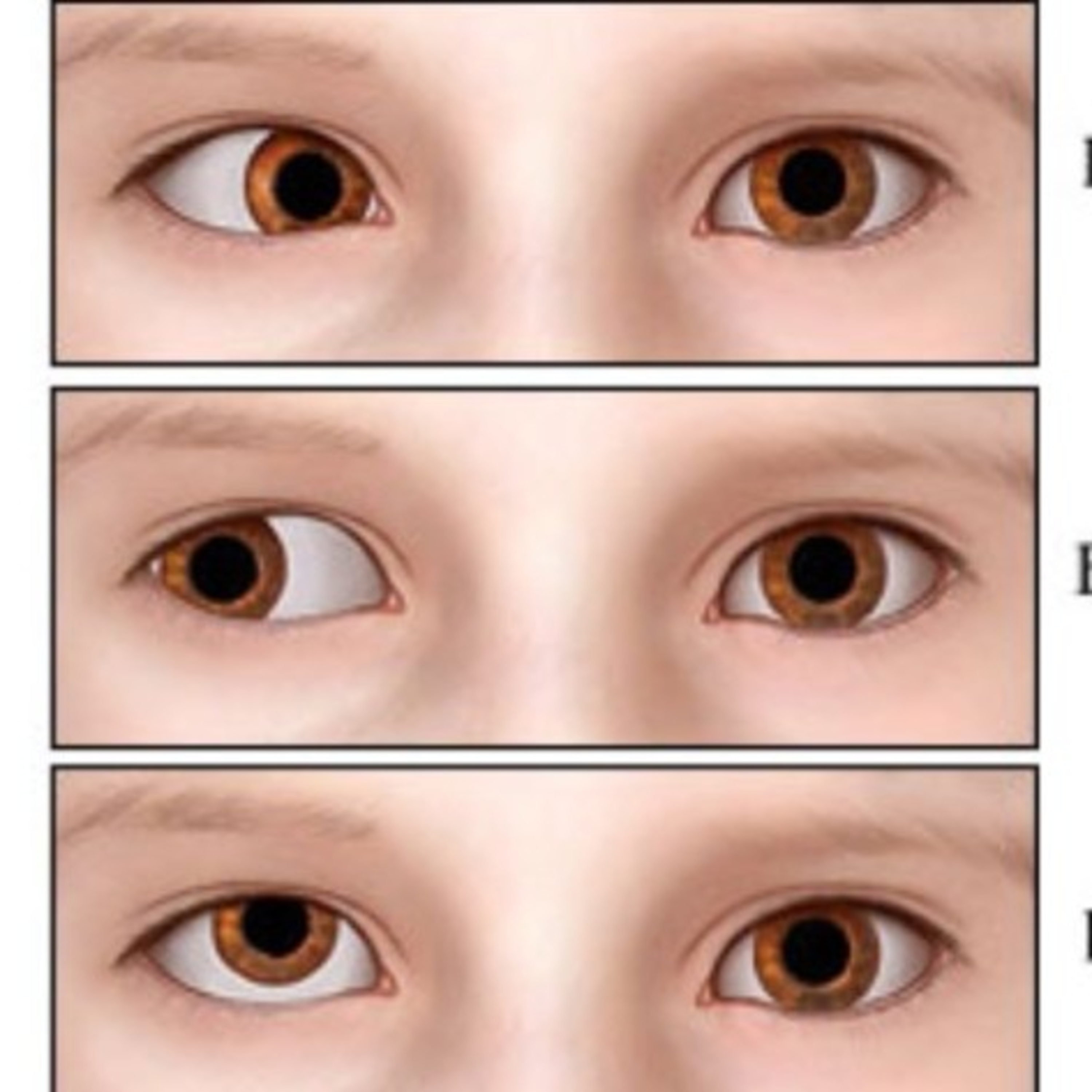 What is “Amblyopia?” [Lazy Eyes] episode artwork