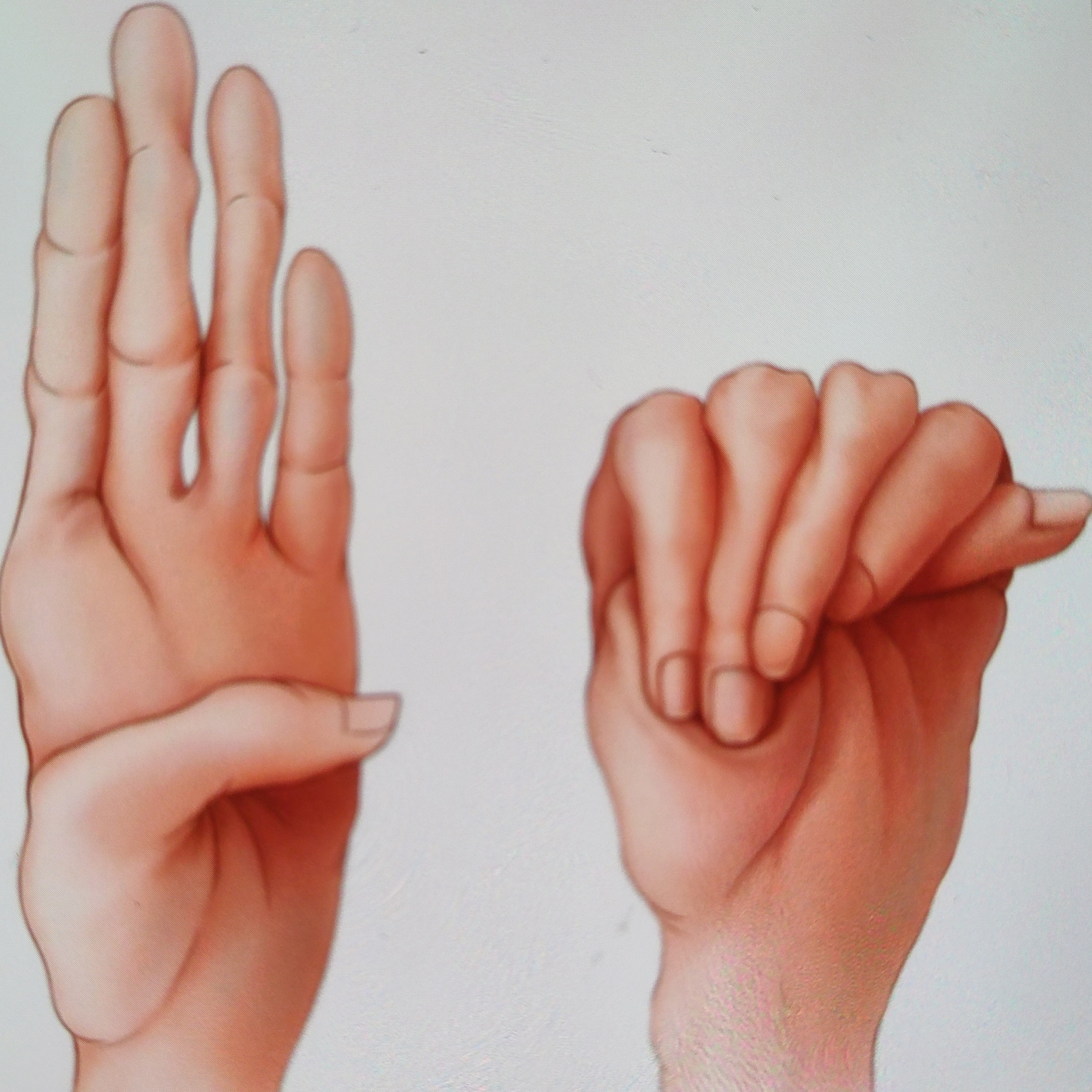 What is Marfan Syndrome? Symptoms and Causes  episode artwork