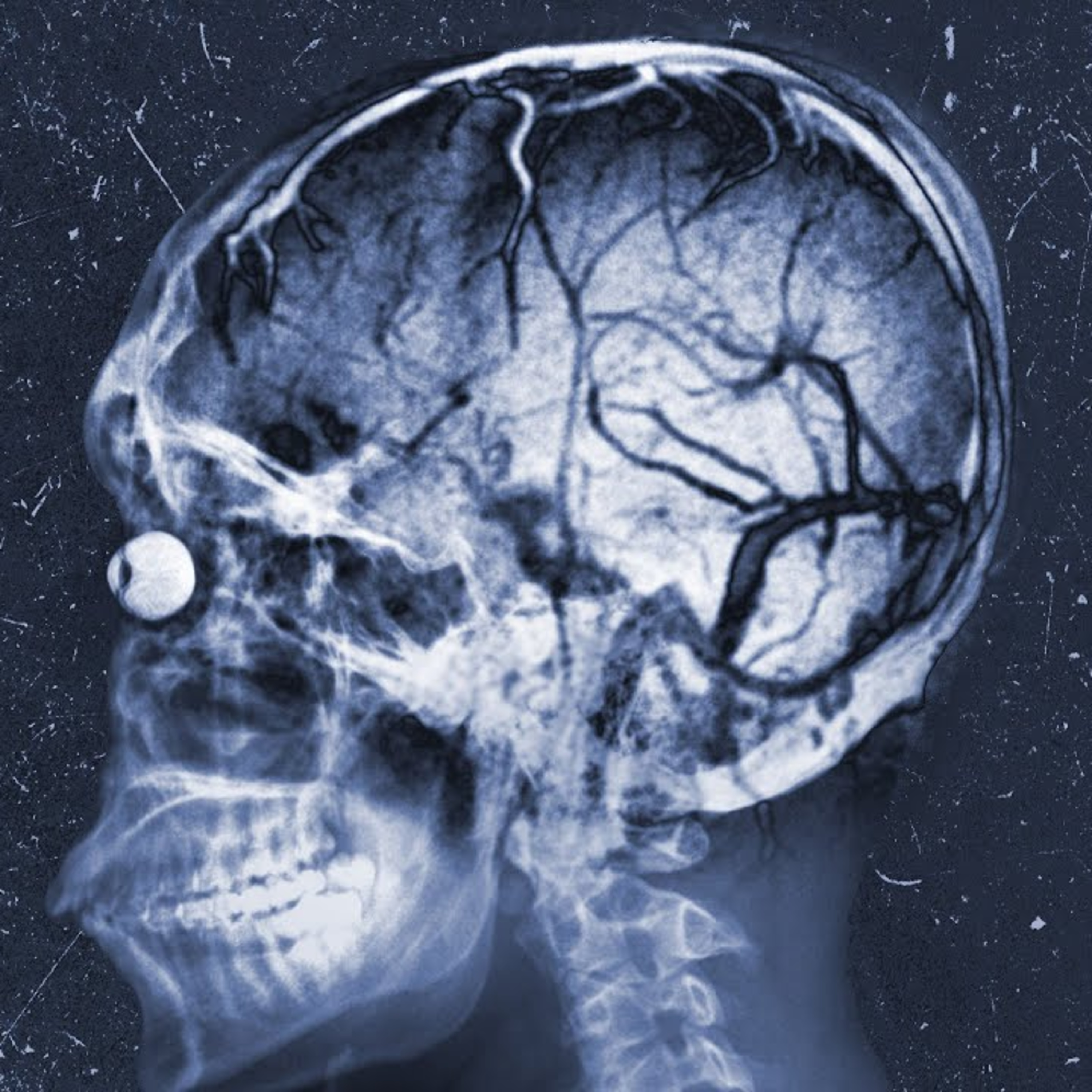 A Bitcoin Miner Heatstroked In His Sleep. This Is What Happened To His Organs