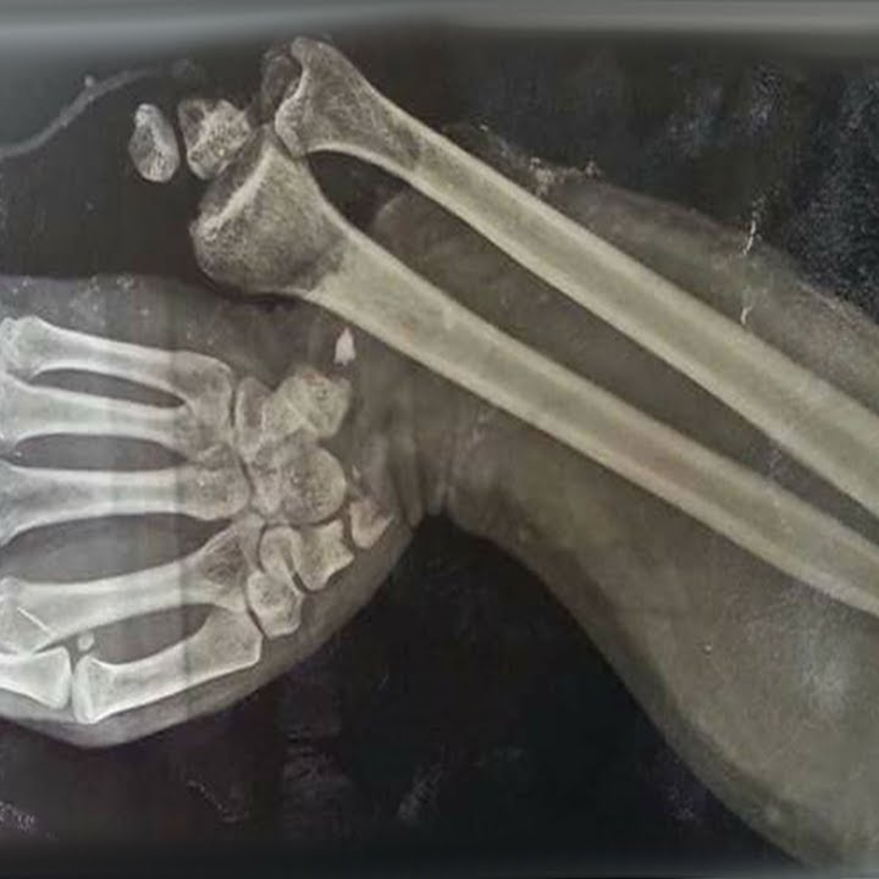 A Boy Ate 150 Gummy Vitamins For Breakfast This Is What Happened To His Bones