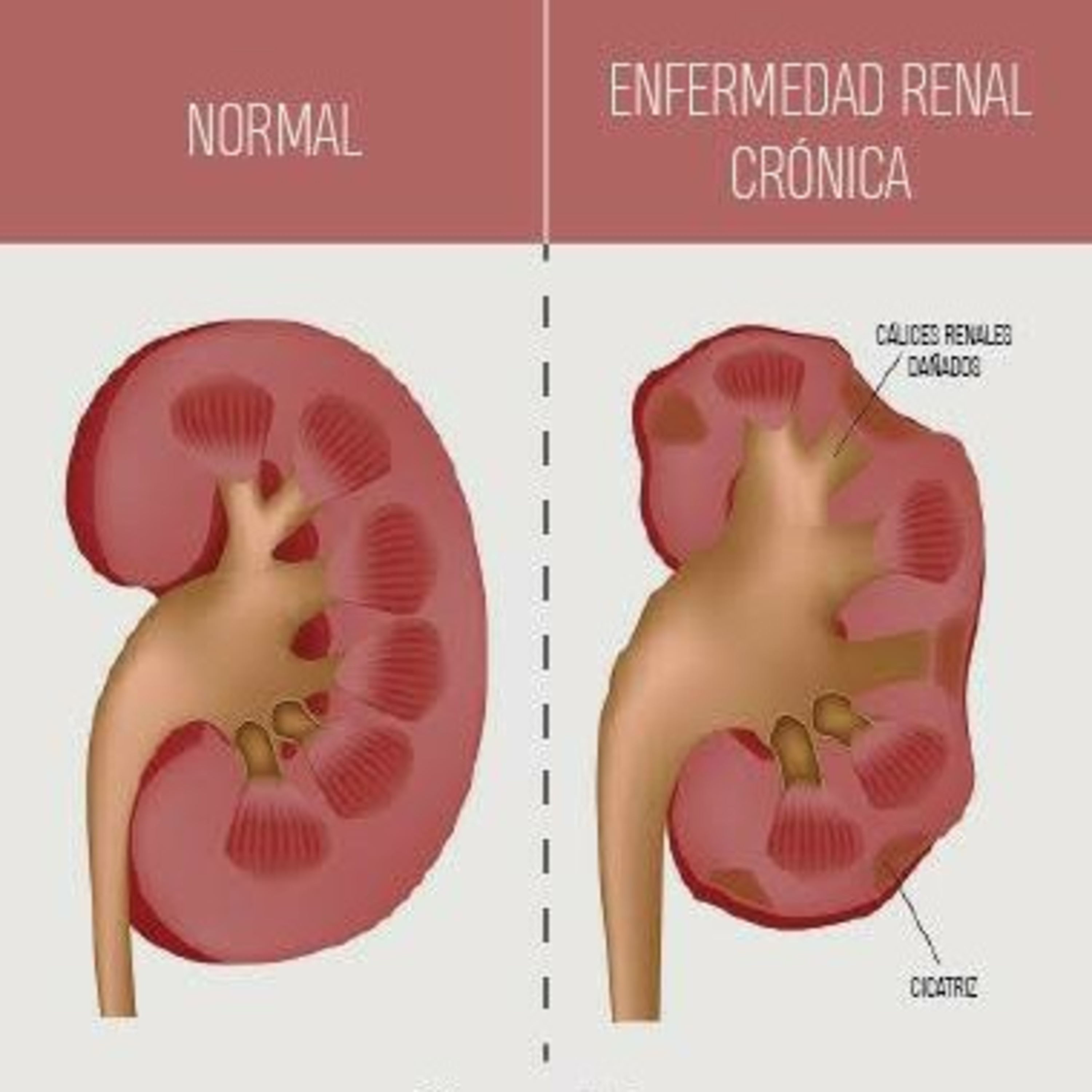 Hipertensión y Como Prevenir