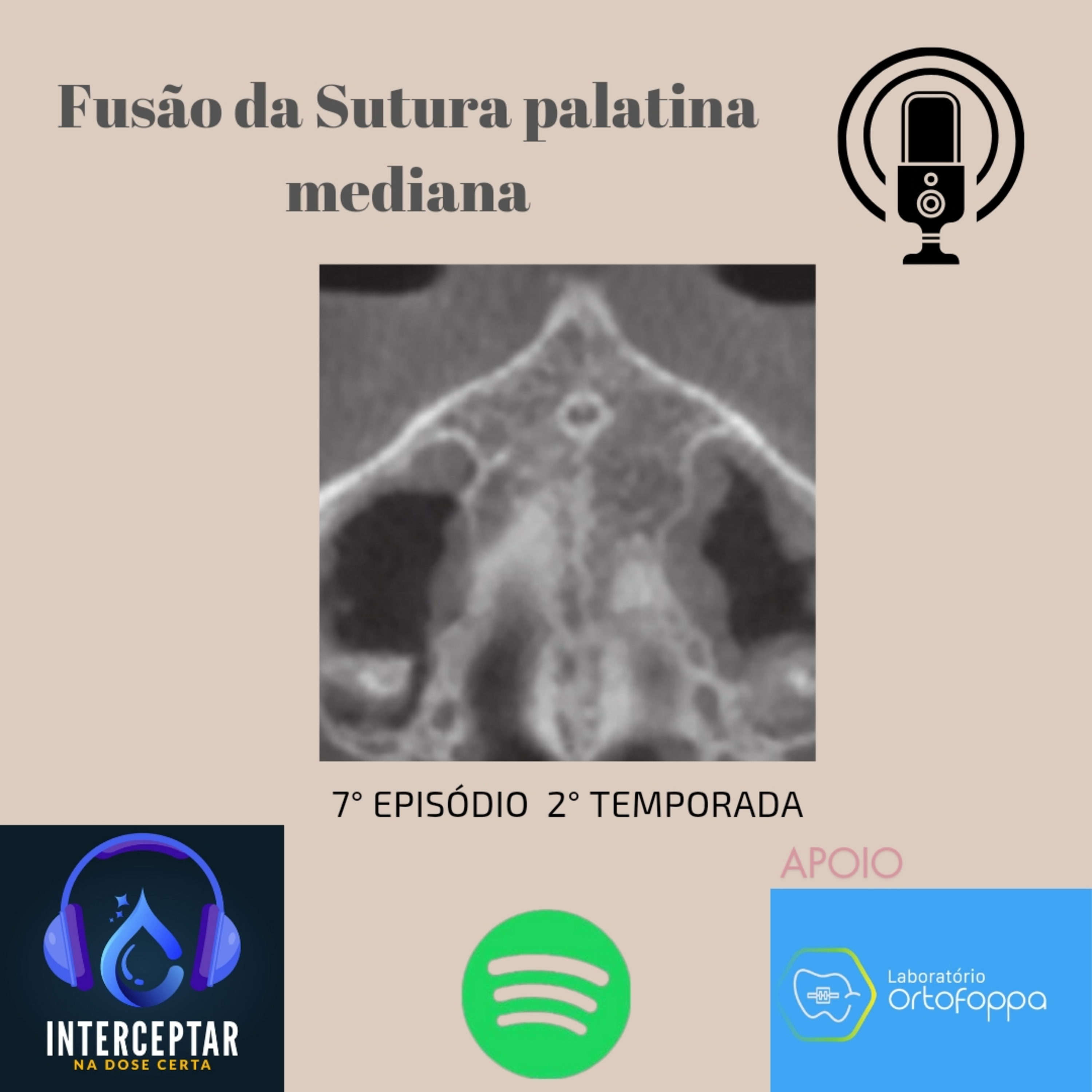Fusão da Sutura Palatina Mediana 