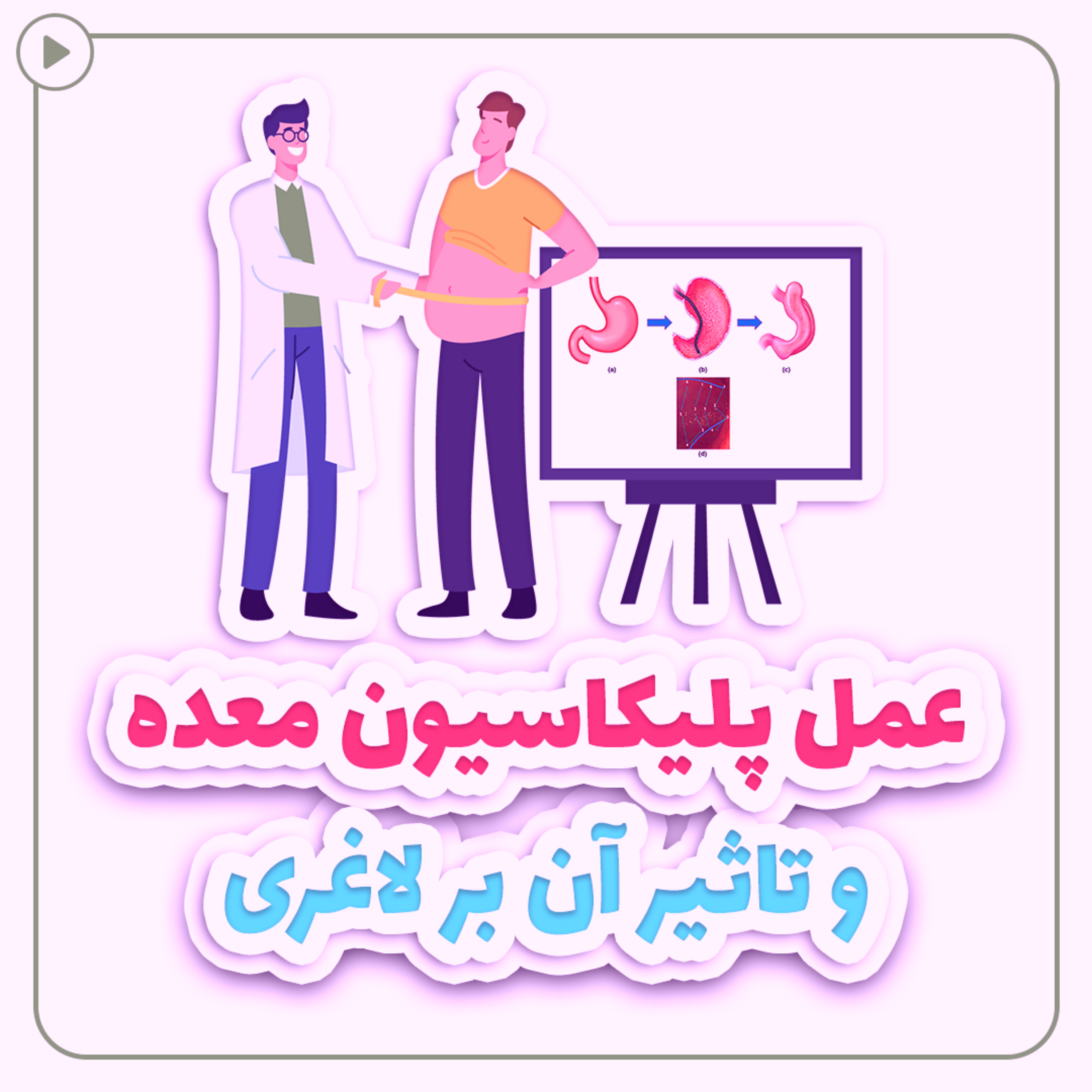 کاور عمل پلیکاسیون معده