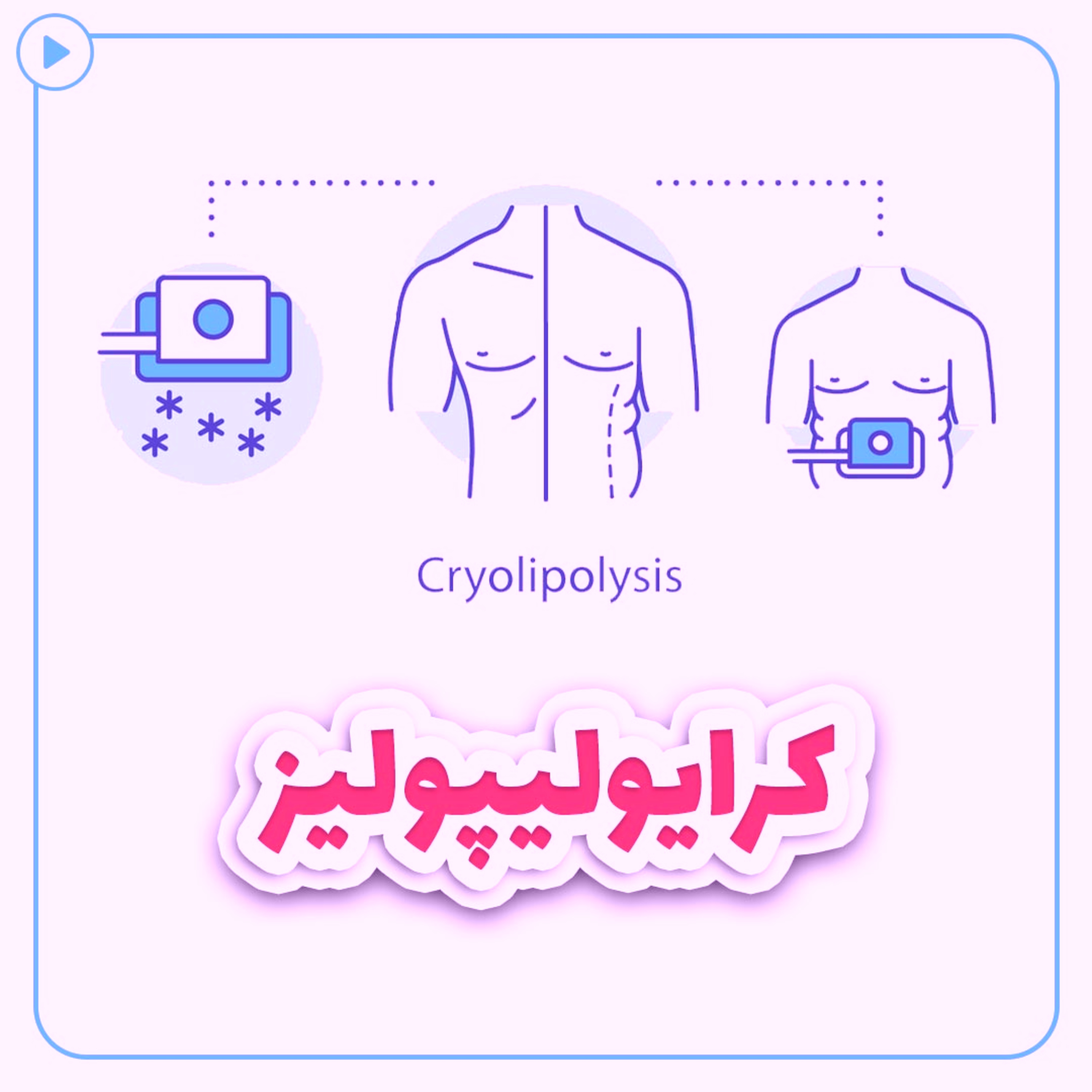 کاور کرایولیپولیز