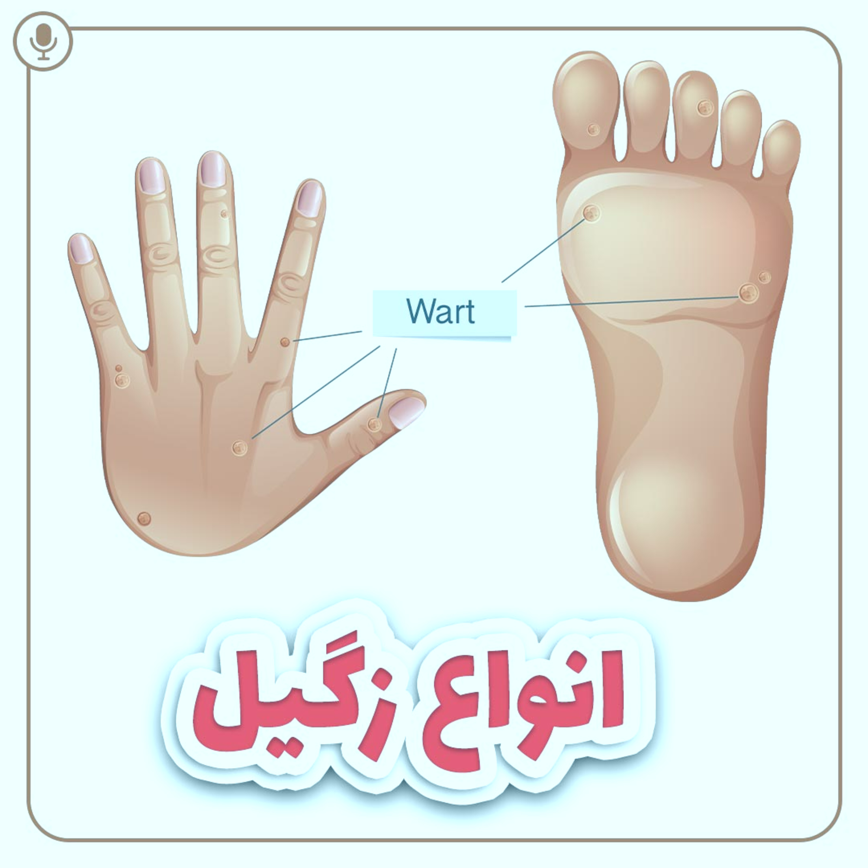 کاور انواع زگیل