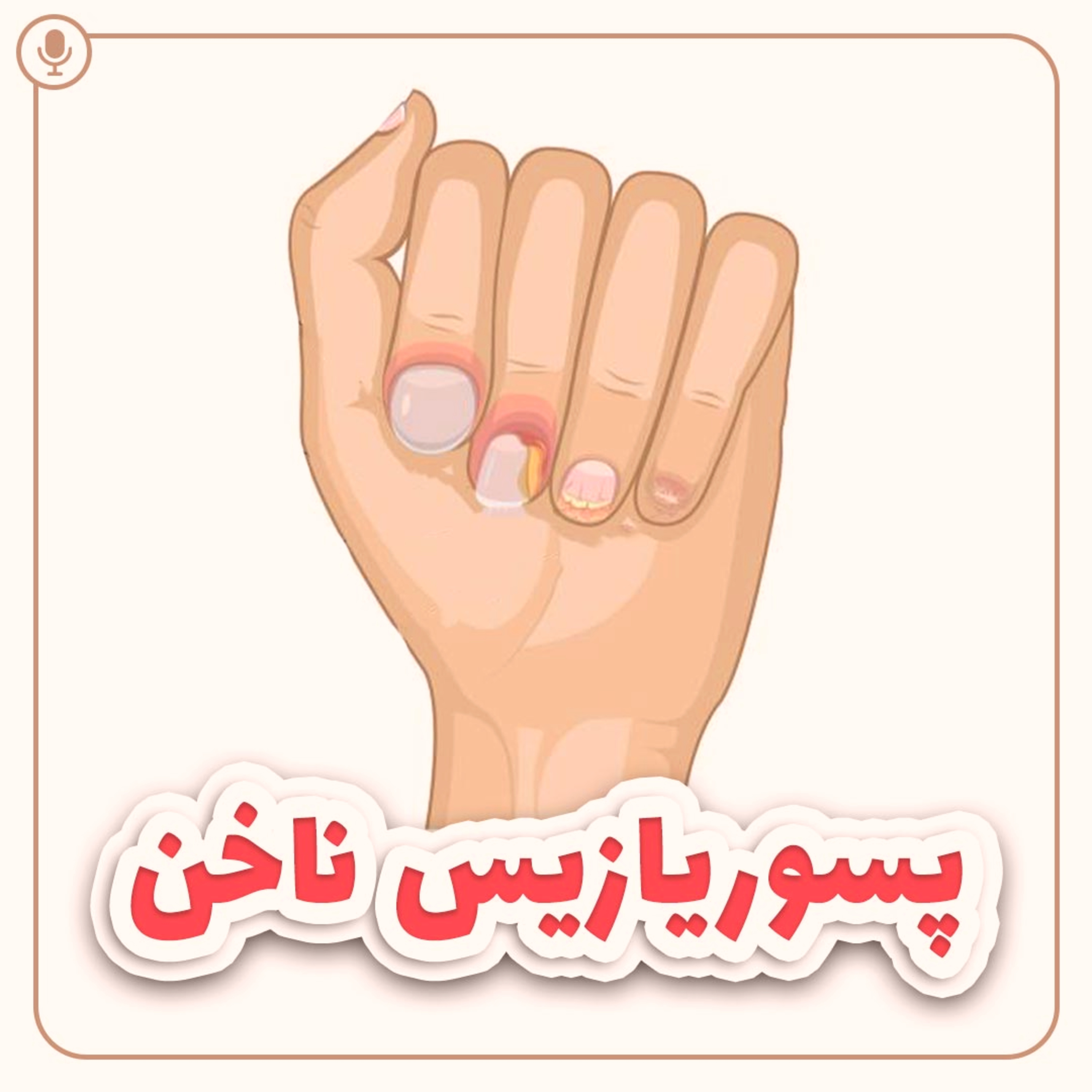 کاور پسوریازیس ناخن