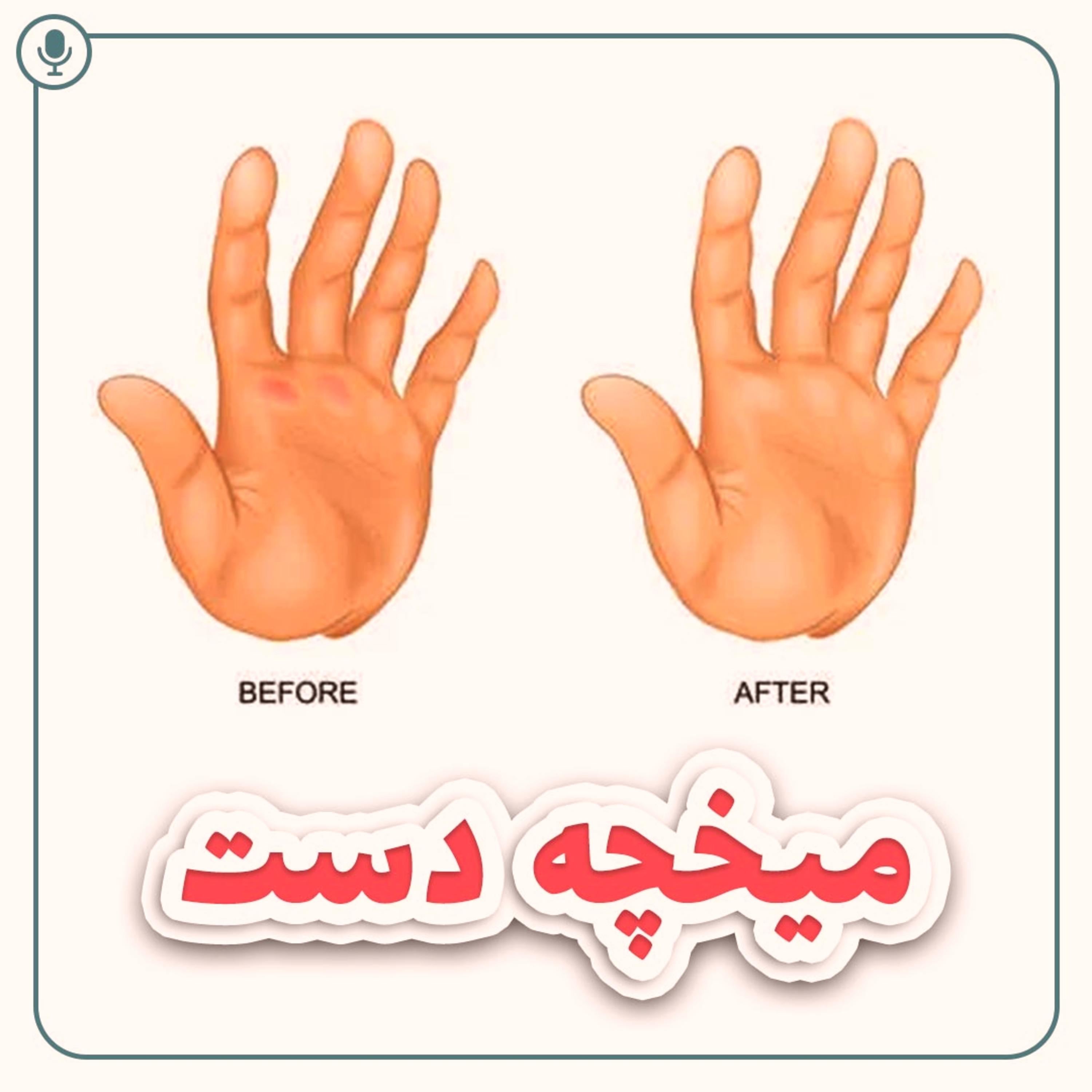 کاور درمان میخچه دست