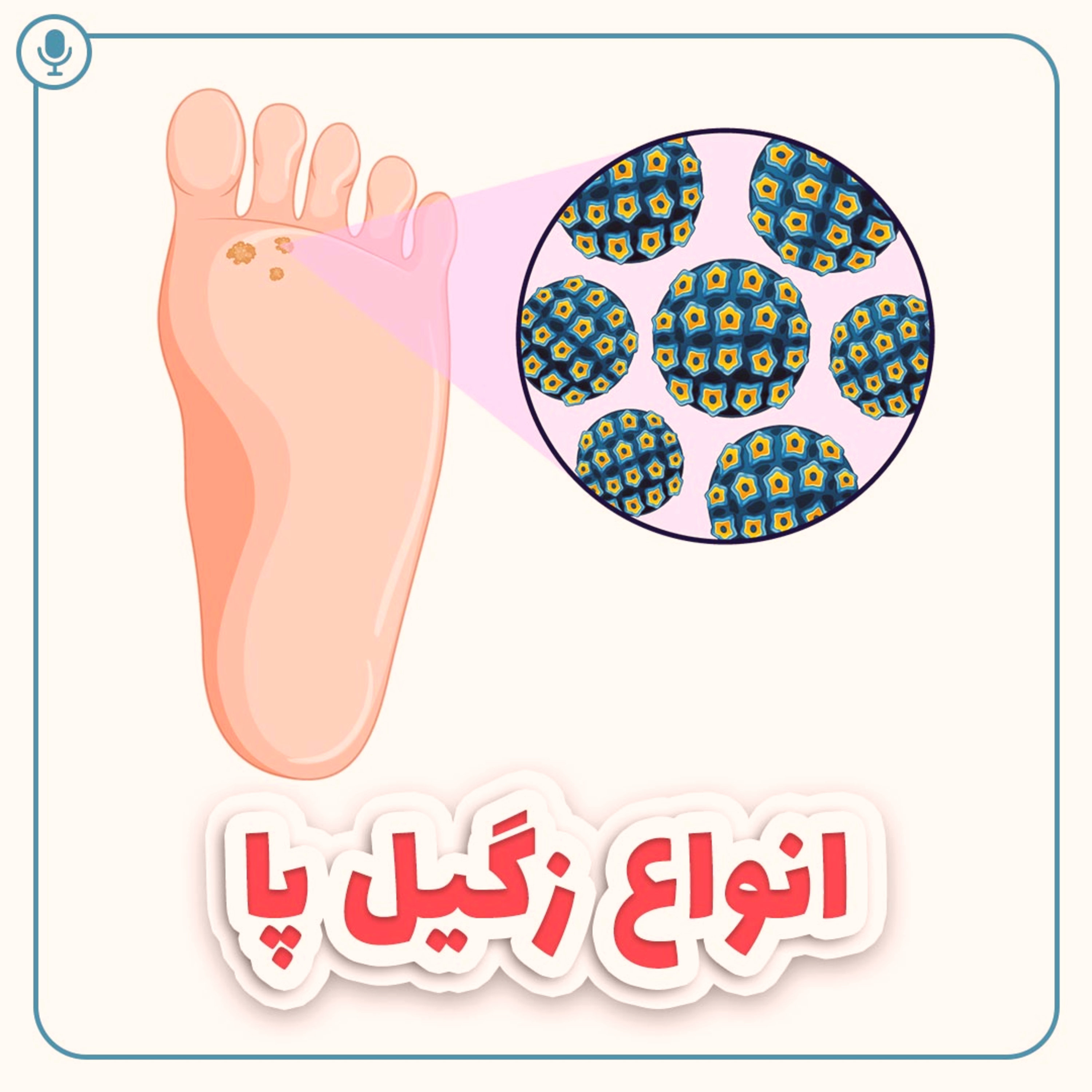 کاور انواع زگیل پا