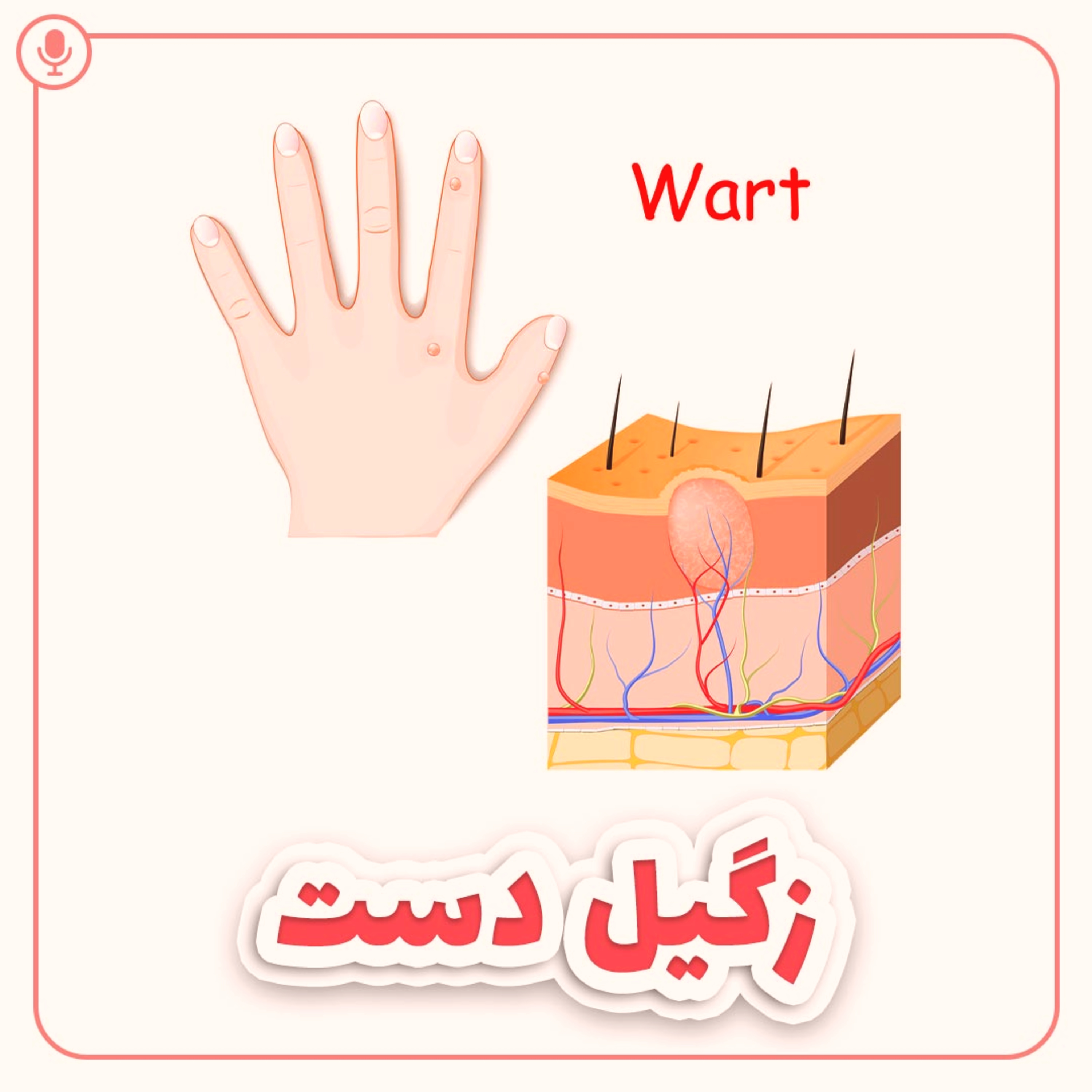کاور زگیل دست