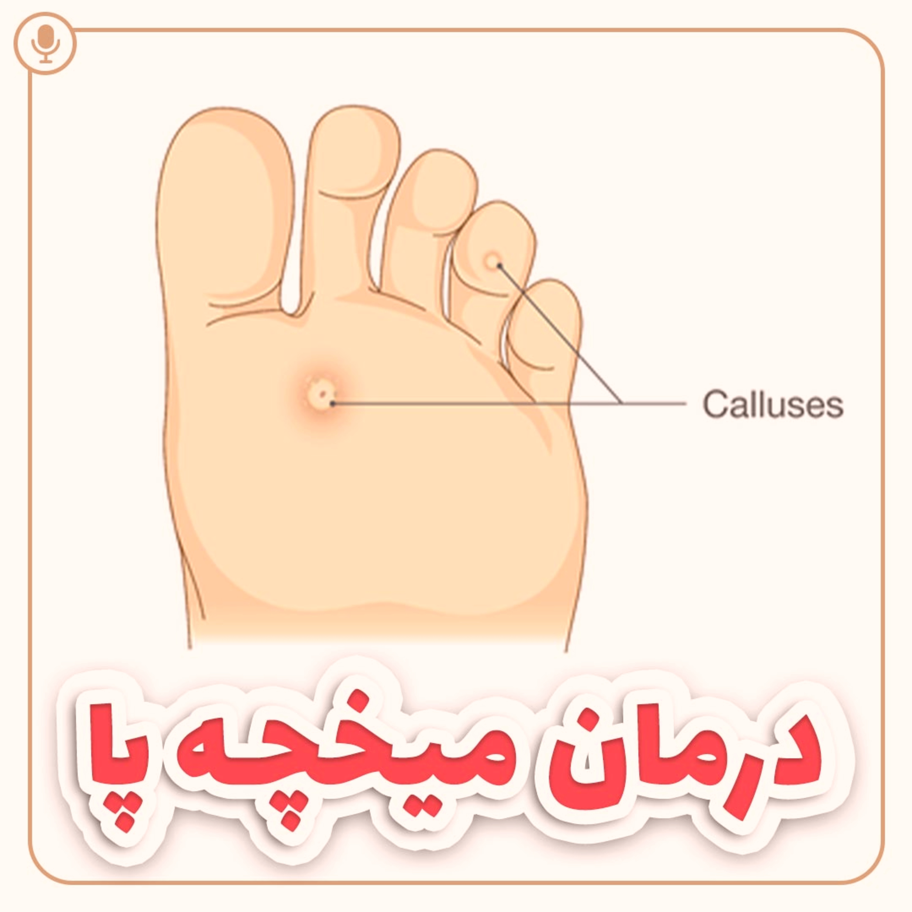 کاور درمان میخچه پا