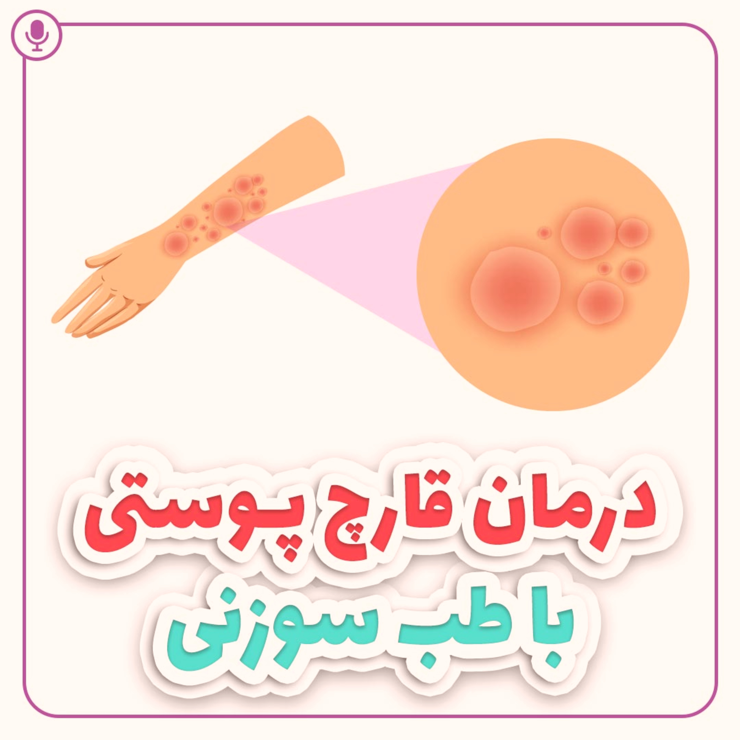 کاور درمان قارچ پوستی با طب سنتی