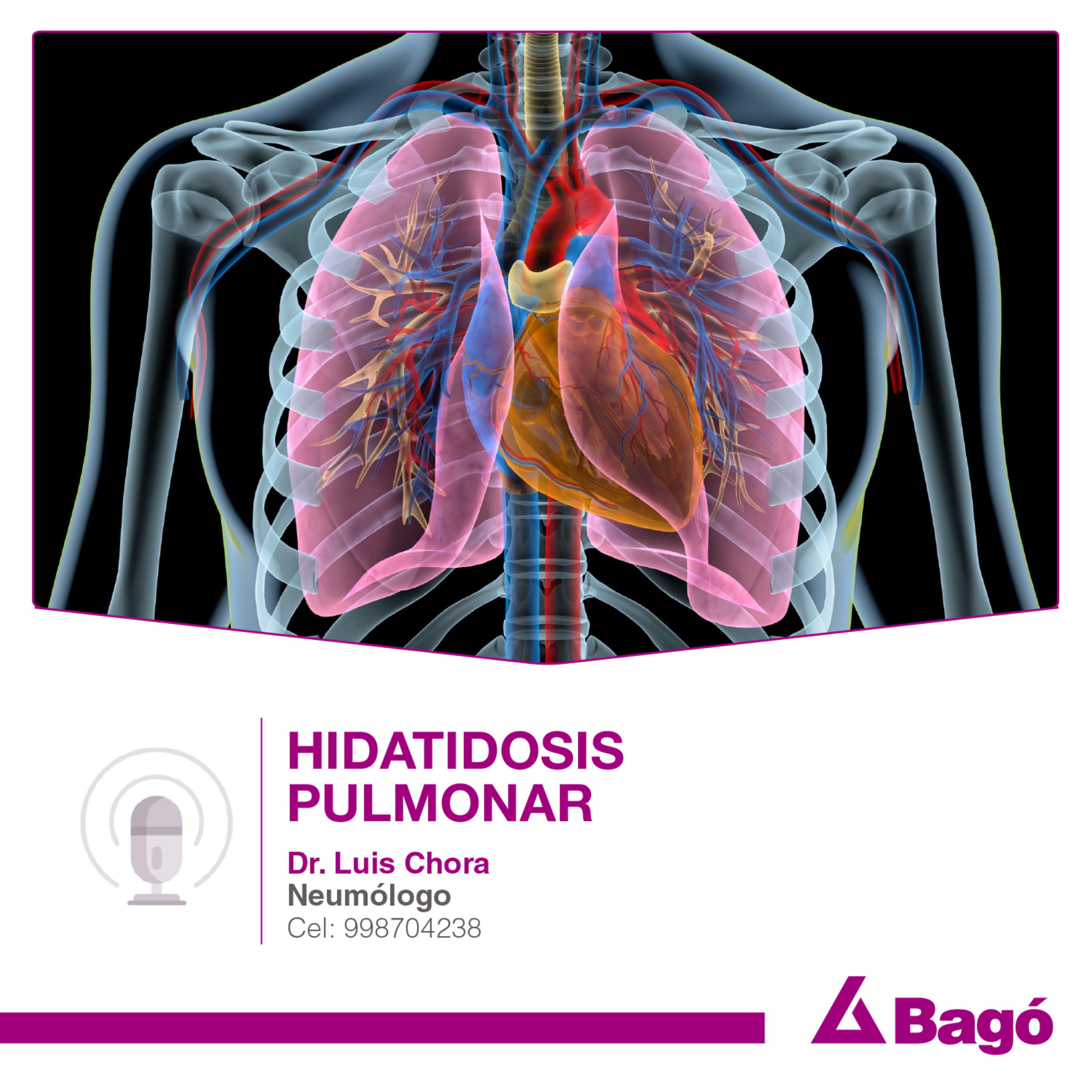 HIDATIDOSIS PULMONAR episode artwork