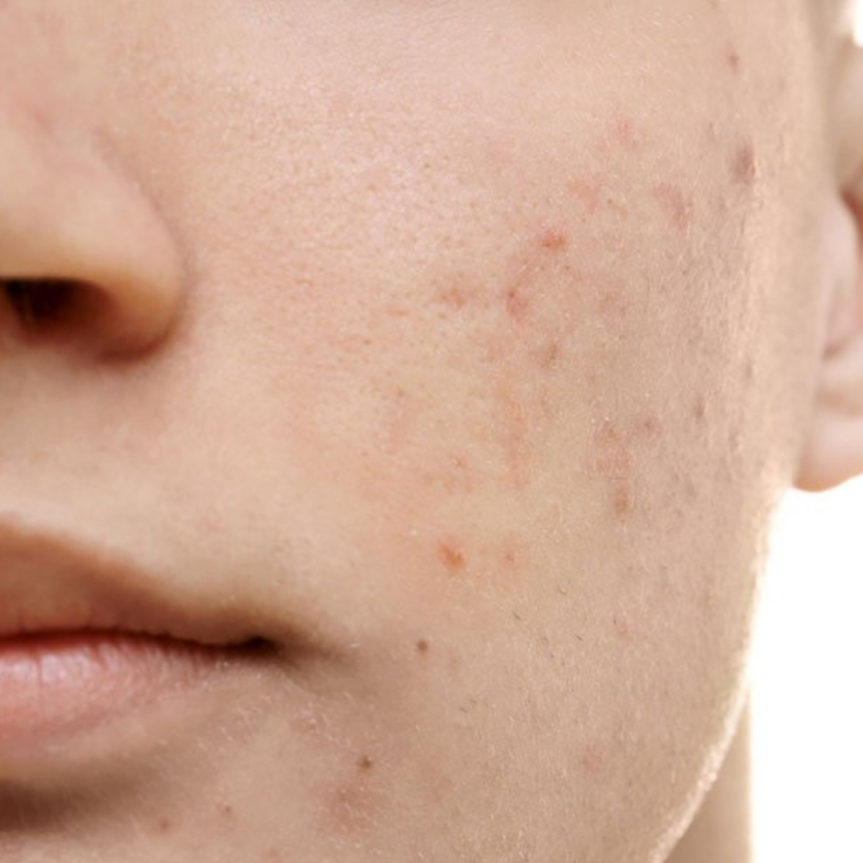 What are the Symptoms of Forms of Acne? episode artwork