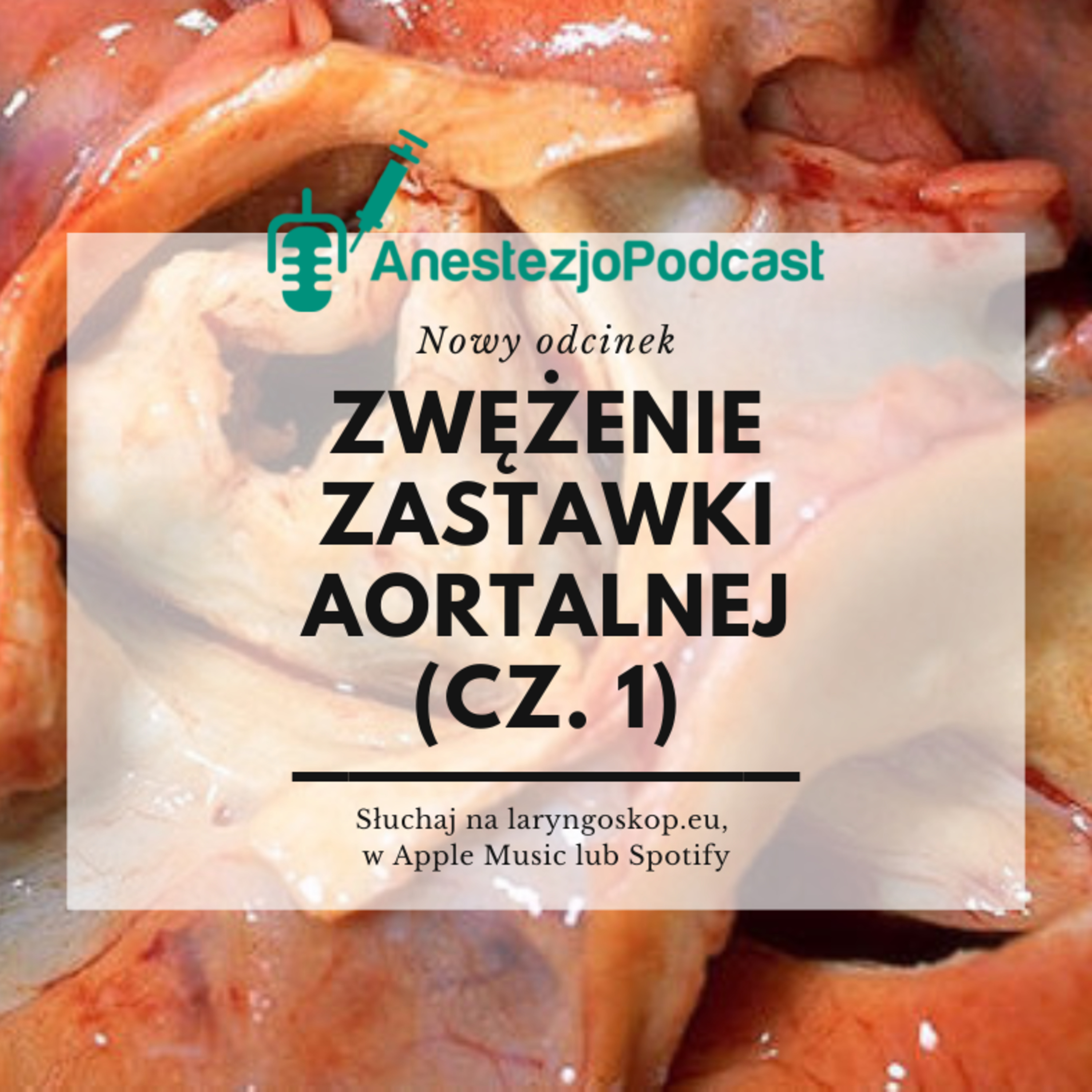 Odcinek 90 - Zwężenie zastawki aortalnej (cz. 1)