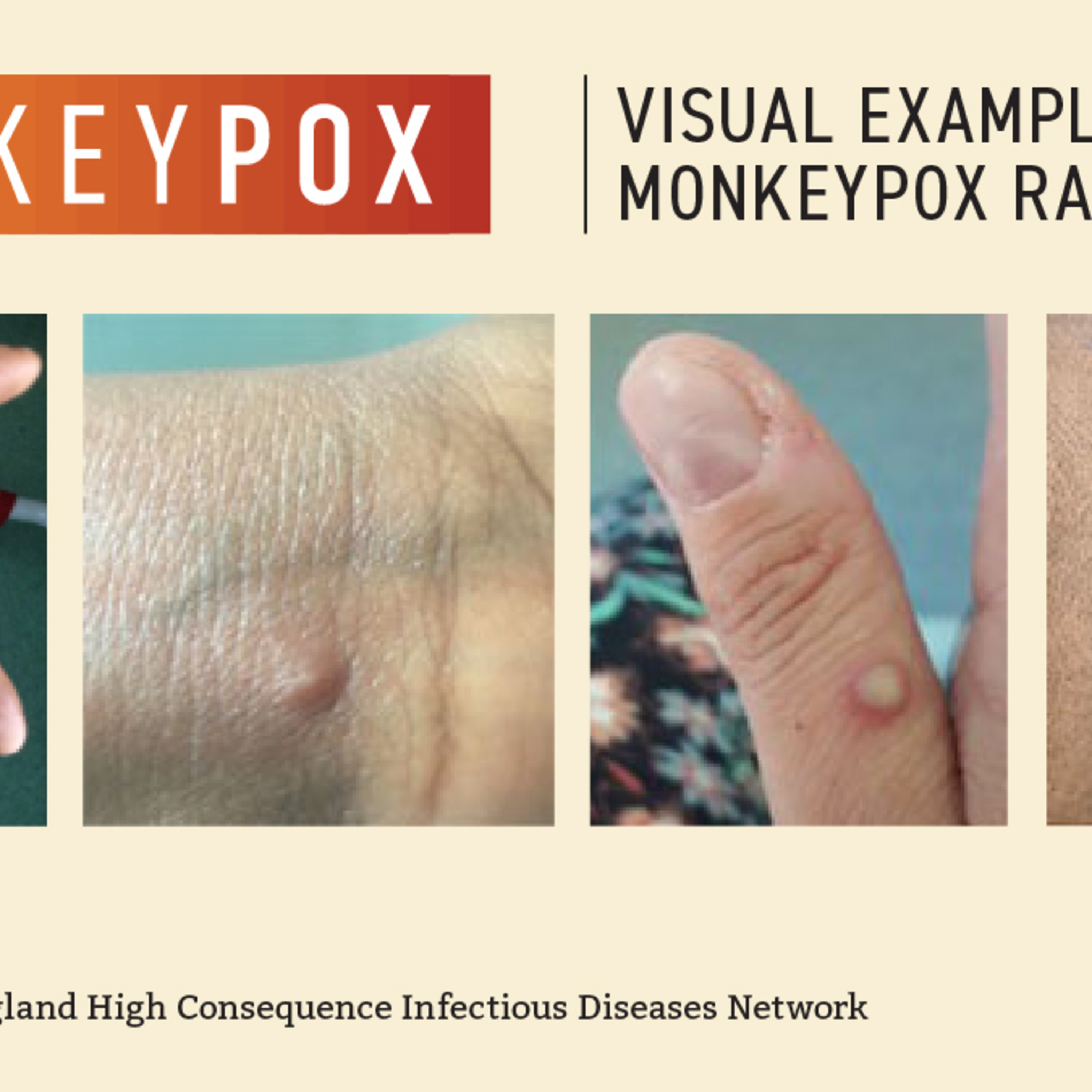 Monkey Pox Update episode artwork