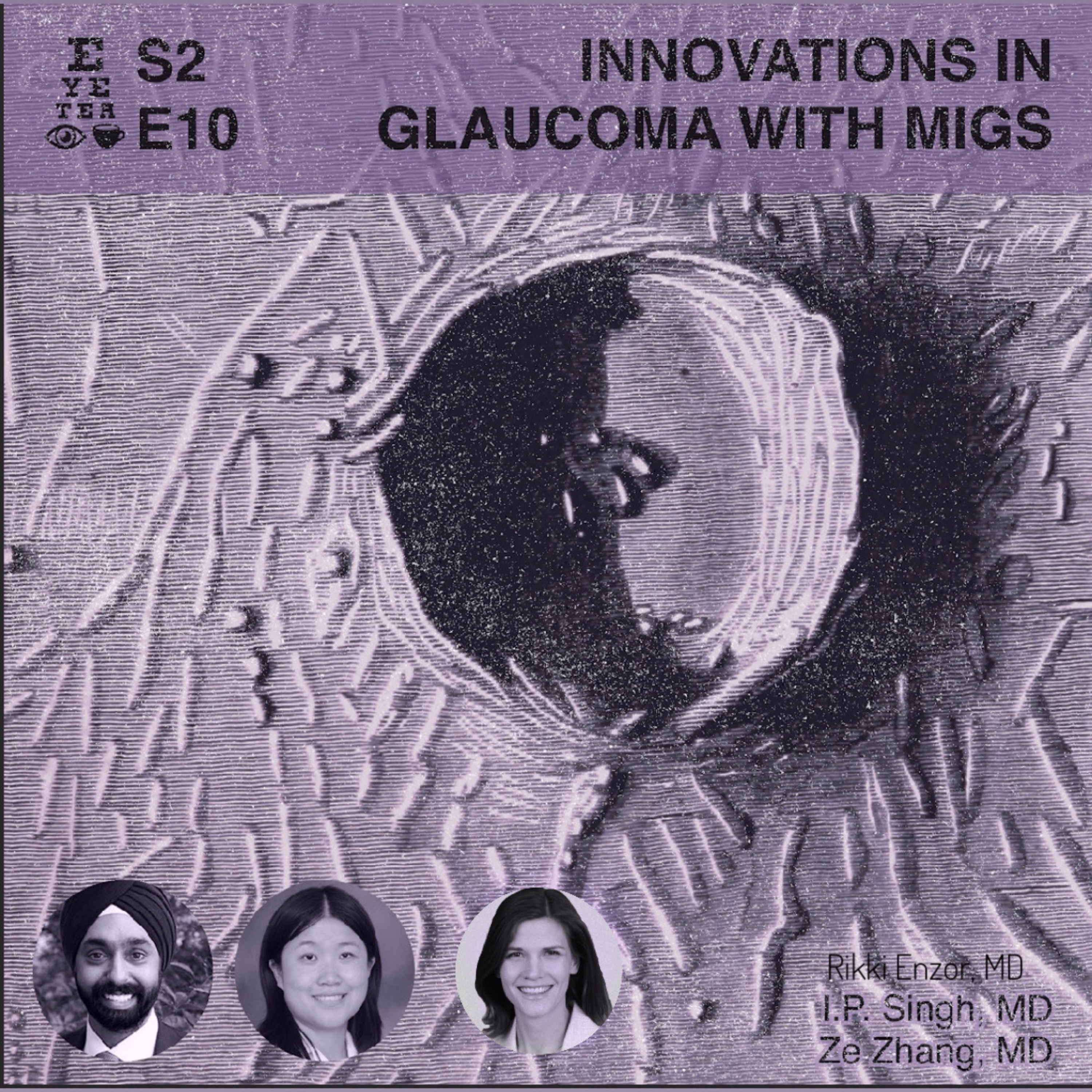 S2:E10 - Eye Tea - MIGS -Glaucoma Innovation - Drs. Inder Paul Singh, Ze Zhang, Rikki Enzor
