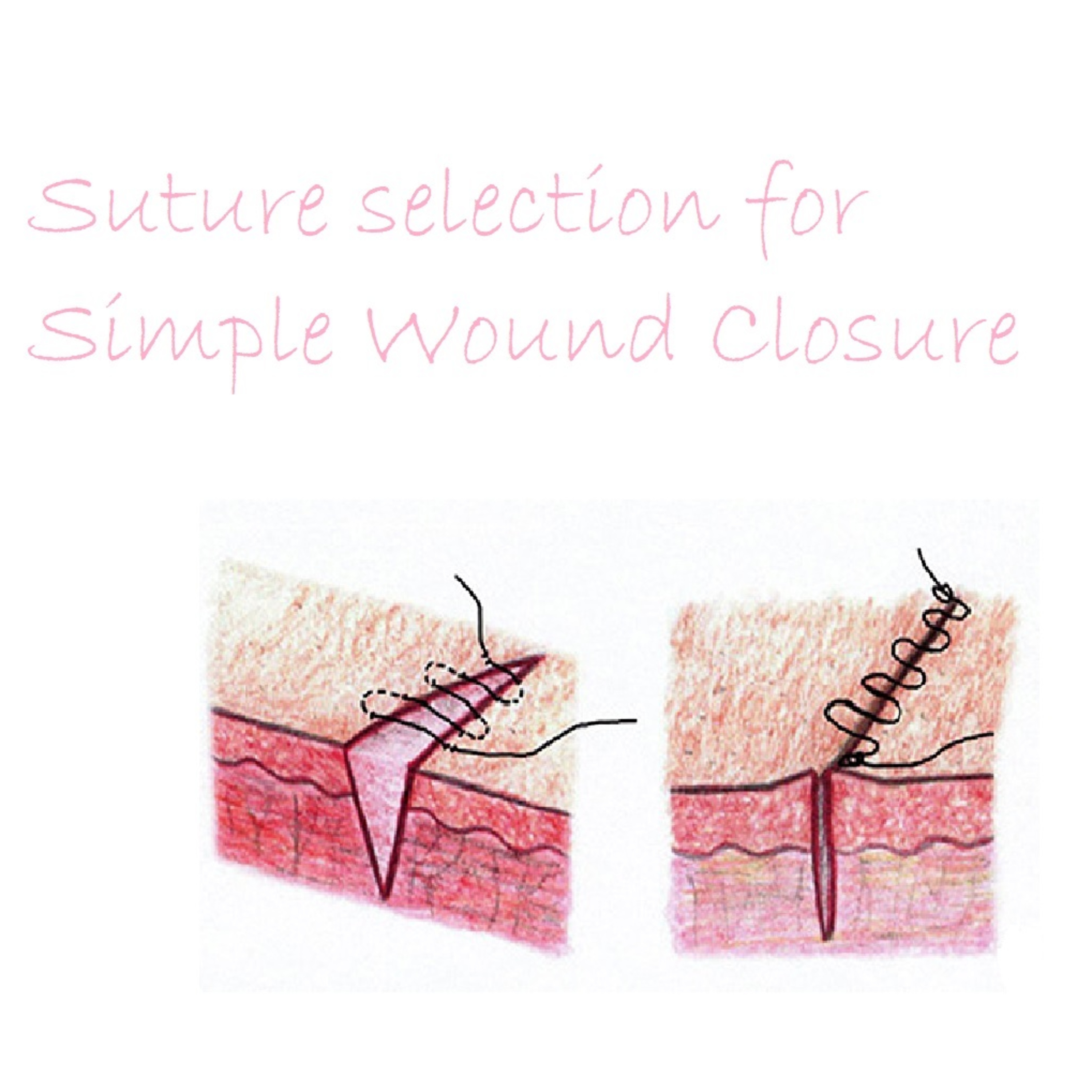 Surgical Suture Selection episode artwork