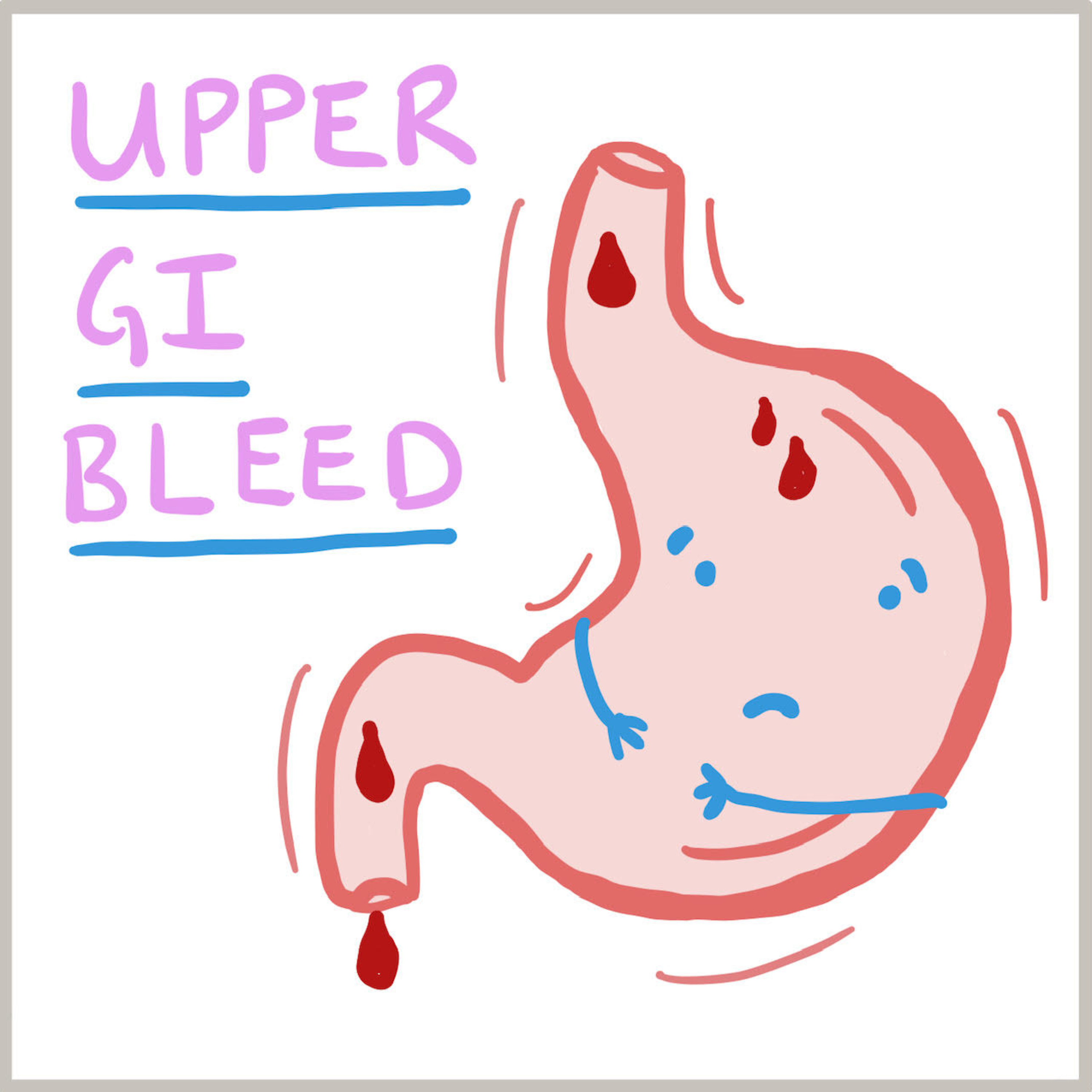 Upper GI bleeding episode artwork