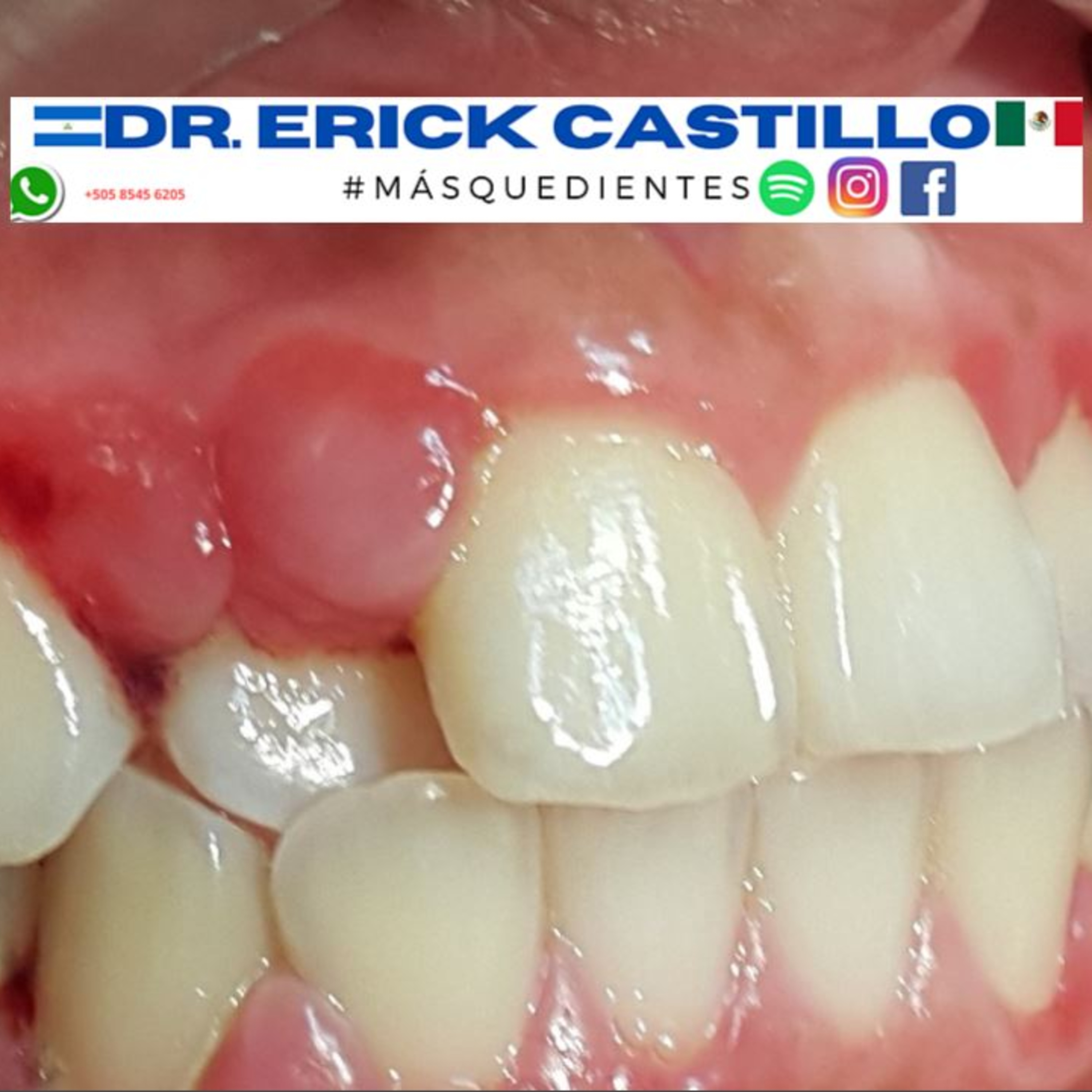 Ver los problemas venir, antes que se desarrollen ¿sangras al cepillarte los dientes? episode artwork