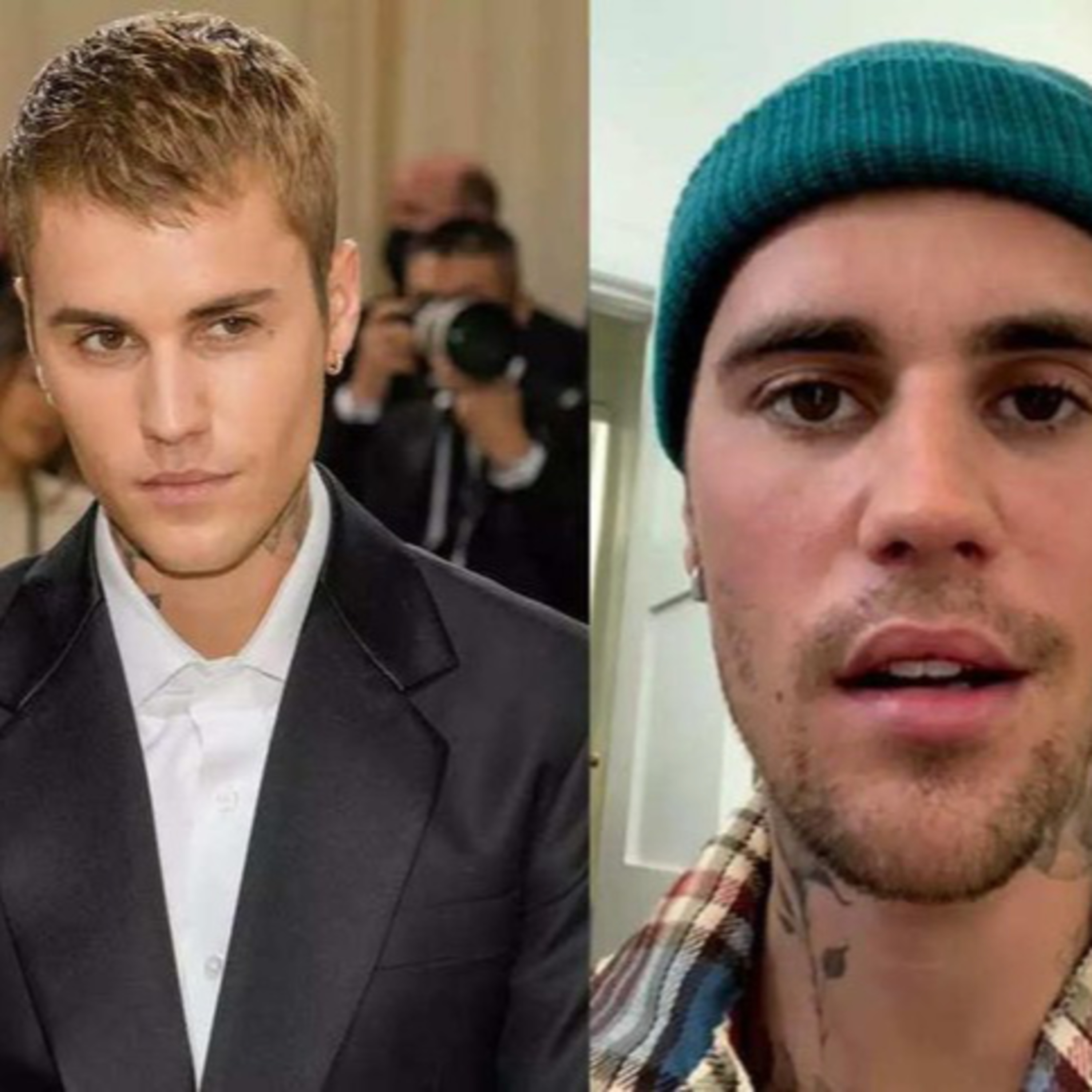 Justin Bieber liệt nửa mặt, chuyên gia lên tiếng về tình trạng của nam ca sĩ episode artwork