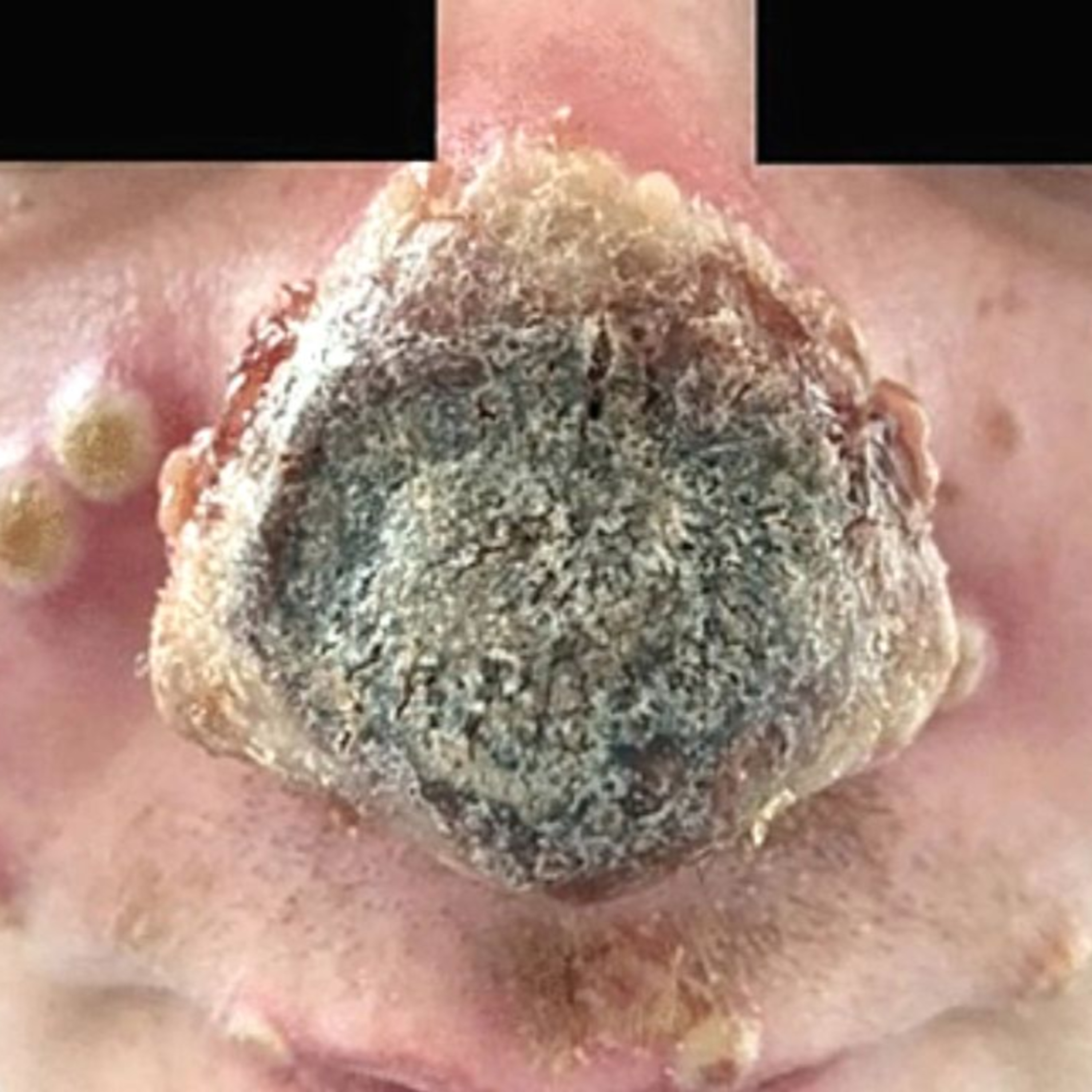 Most SHOCKING Monkeypox Case episode artwork