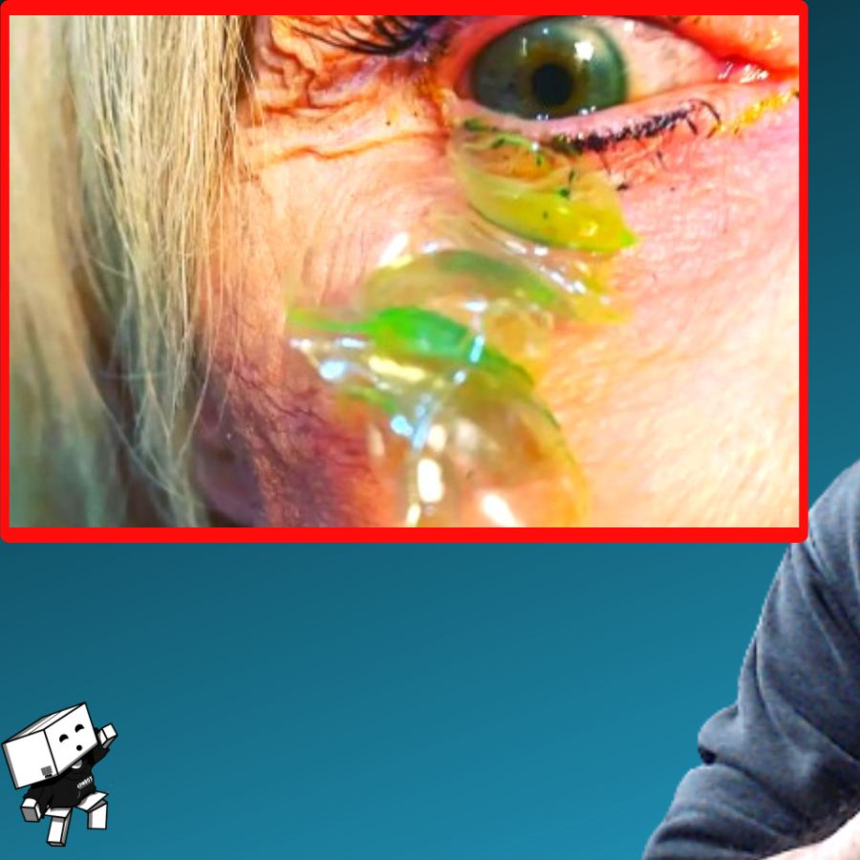 SHOCKING VIDEO SHOWS DOCTOR REMOVING 23 CONTACTS FROM EYE episode artwork