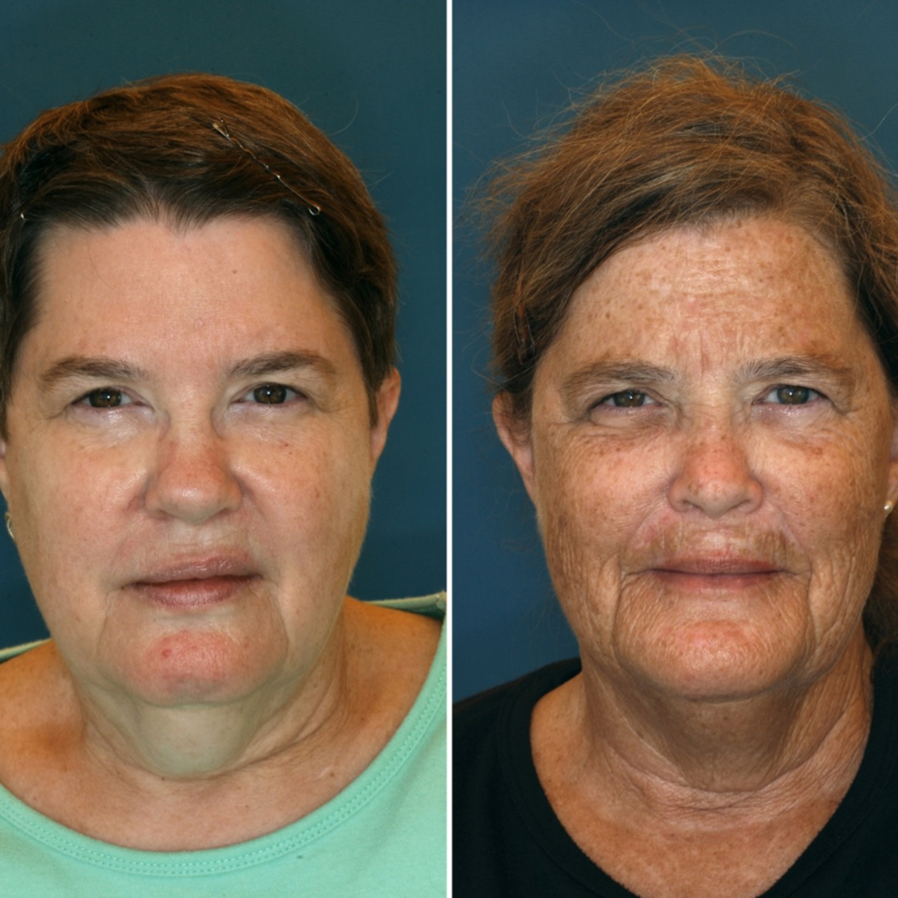 Harmonizaçao Orofacial