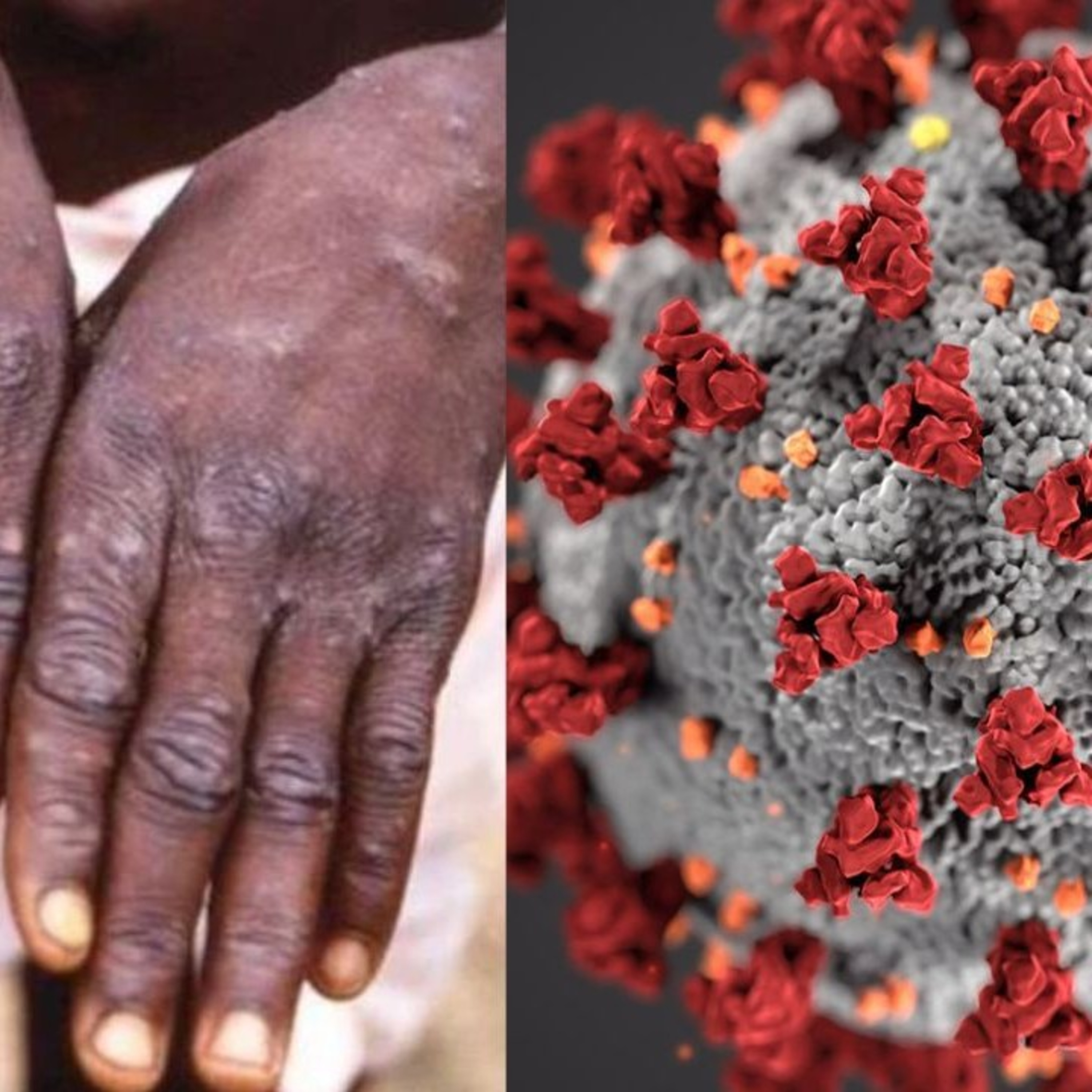 How dangerous is monkeypox?🐵🙈🙉🐒🙊🦍🦍 episode artwork