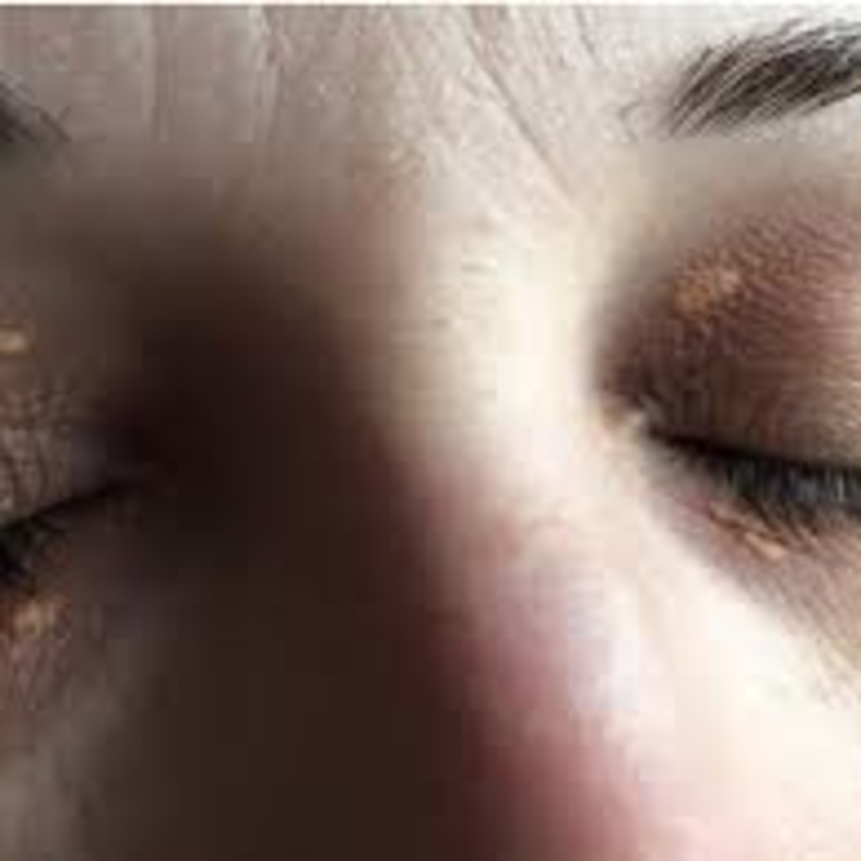 Faq About Xanthelasma  episode artwork