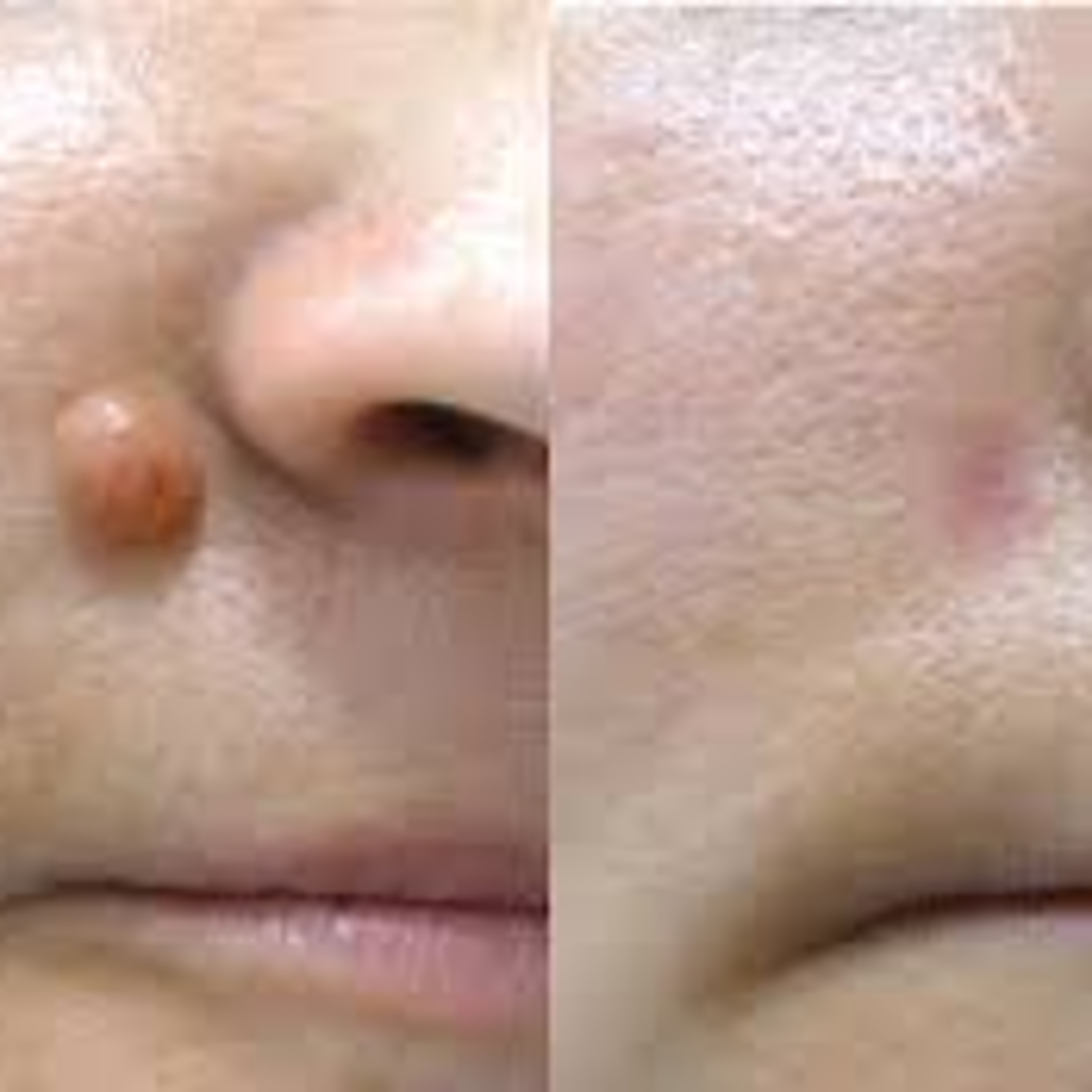 Mole Removal Case study 2 episode artwork