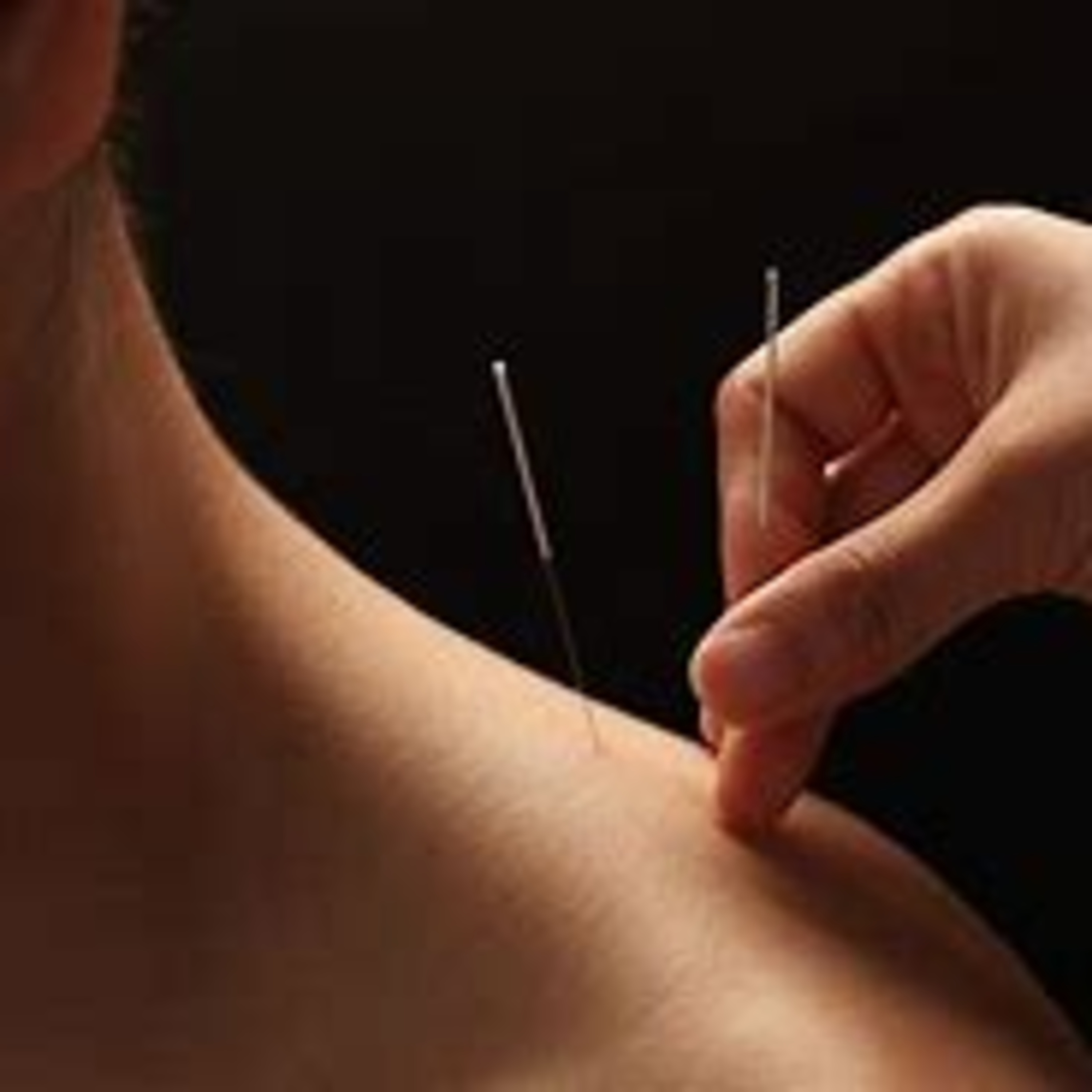 My Acupuncture Experience episode artwork