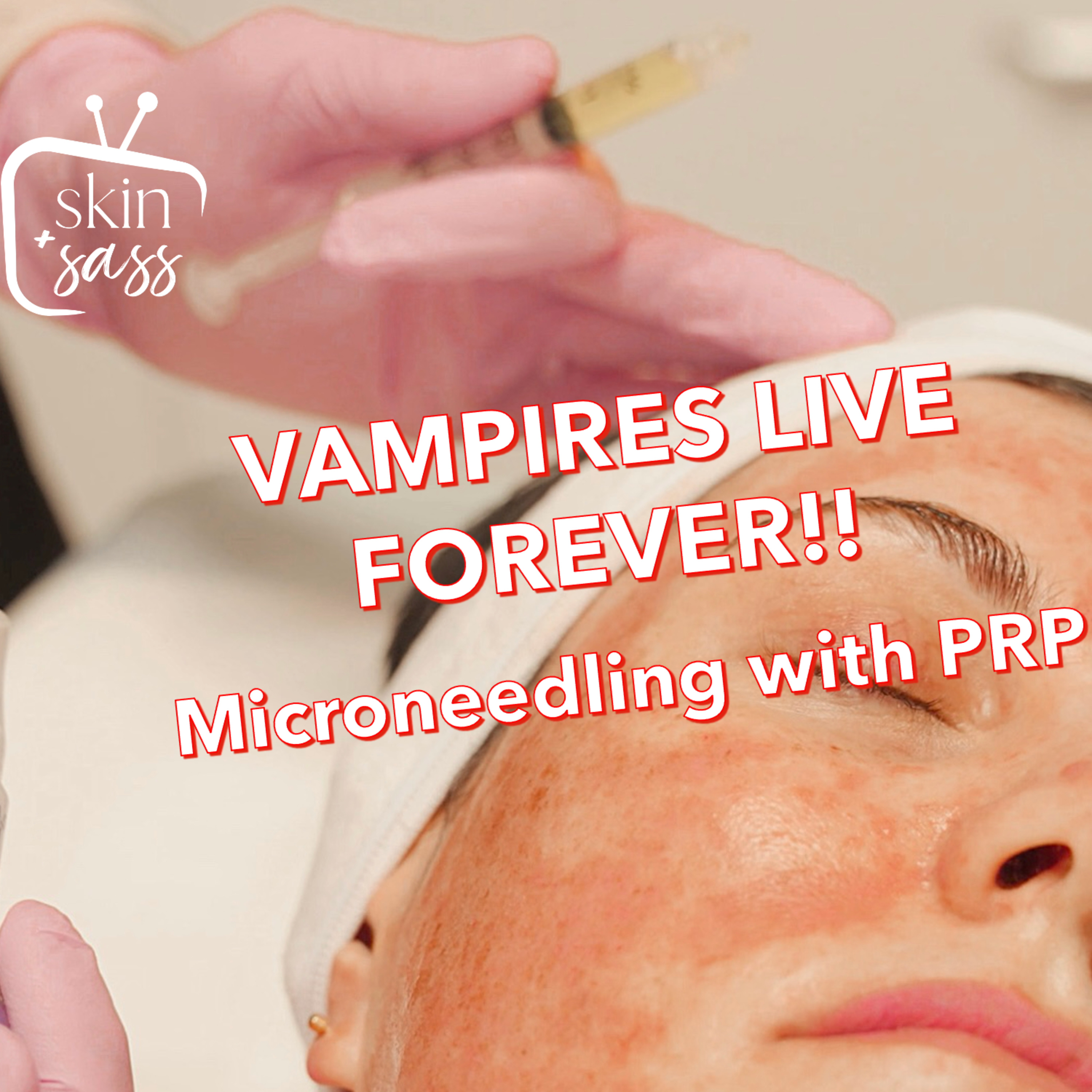 VAMPIRES LIVE FOREVER: MICRONEEDLING WITH PRP episode artwork
