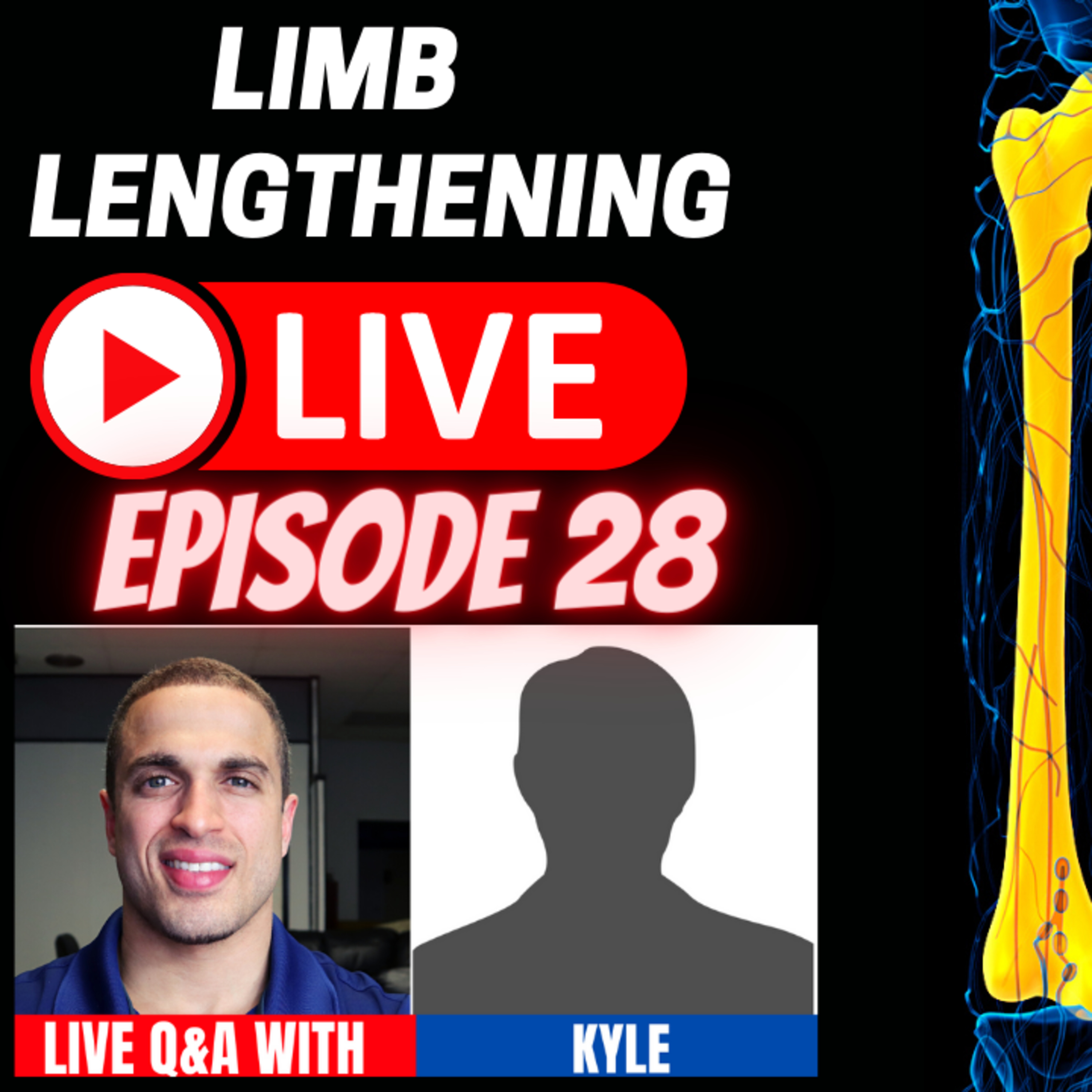 Leg Lengthening Podcast Episode 58 - Limb Lengthening LIVE Episode 28 - CLL Patient - Kyle