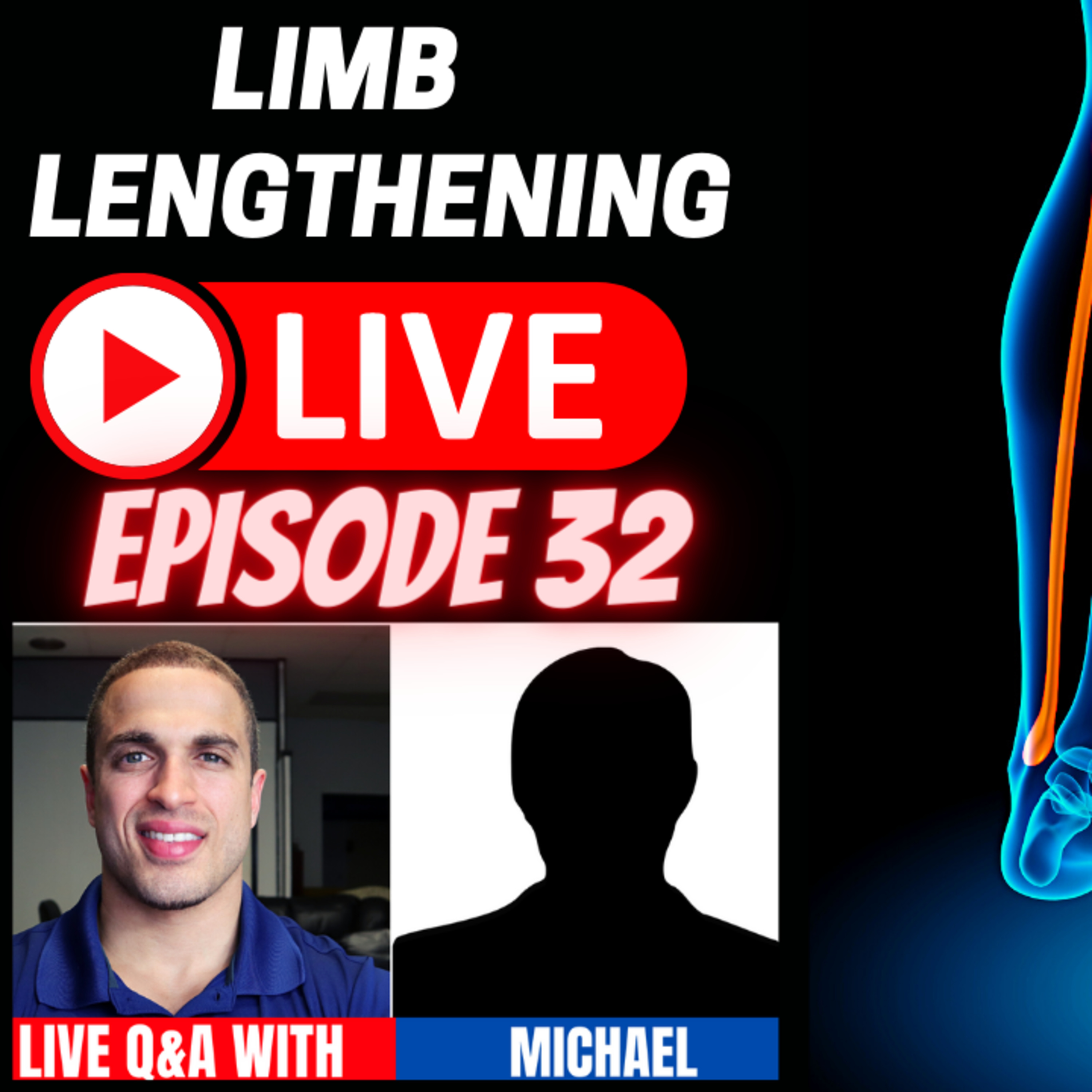 Leg Lengthening Podcast Episode 62 - Limb Lengthening LIVE Episode 32 - CLL Patient - Michael