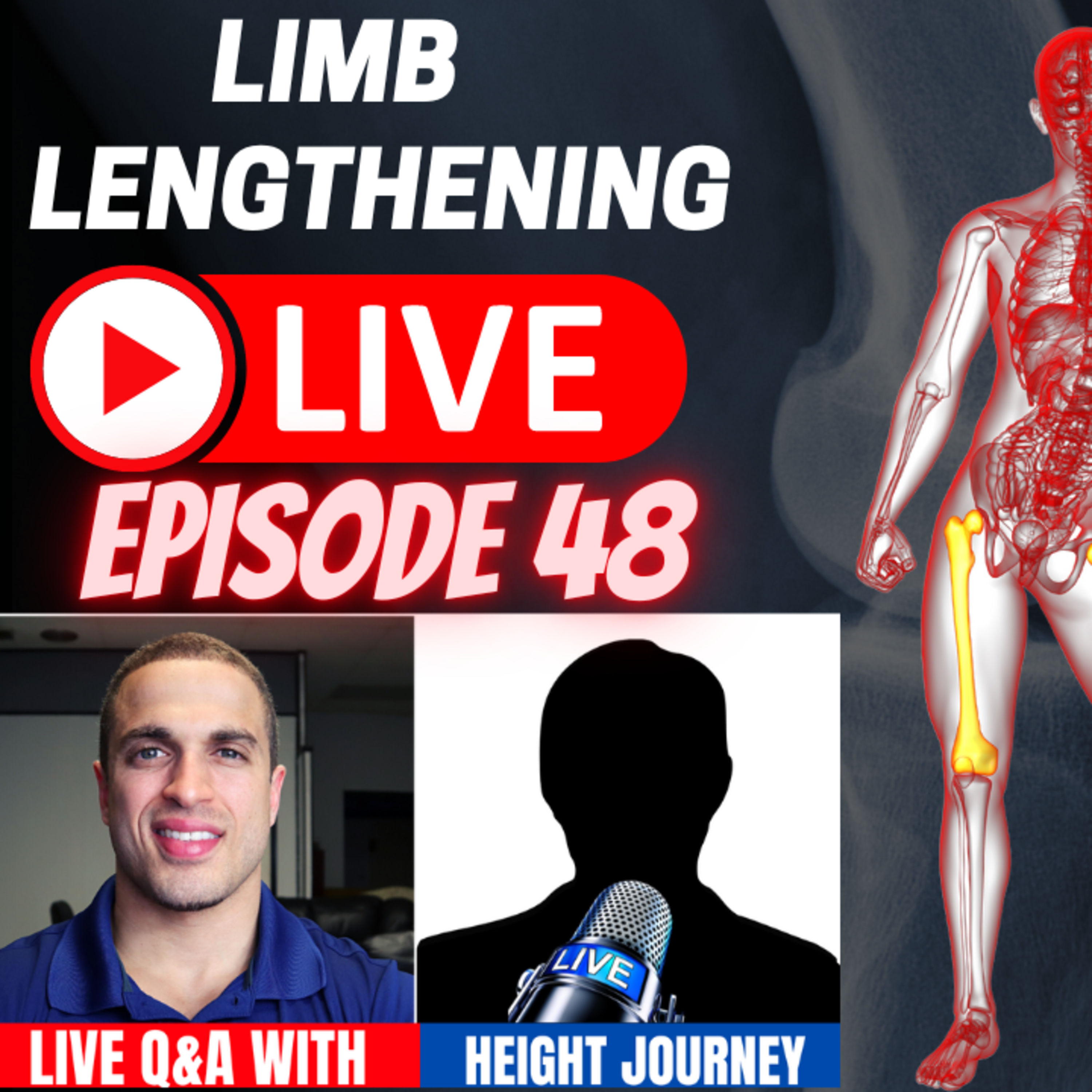 Limb Lengthening LIVE - Episode 48 - LIVE Q&A with HJ on his Tibial Lengthening