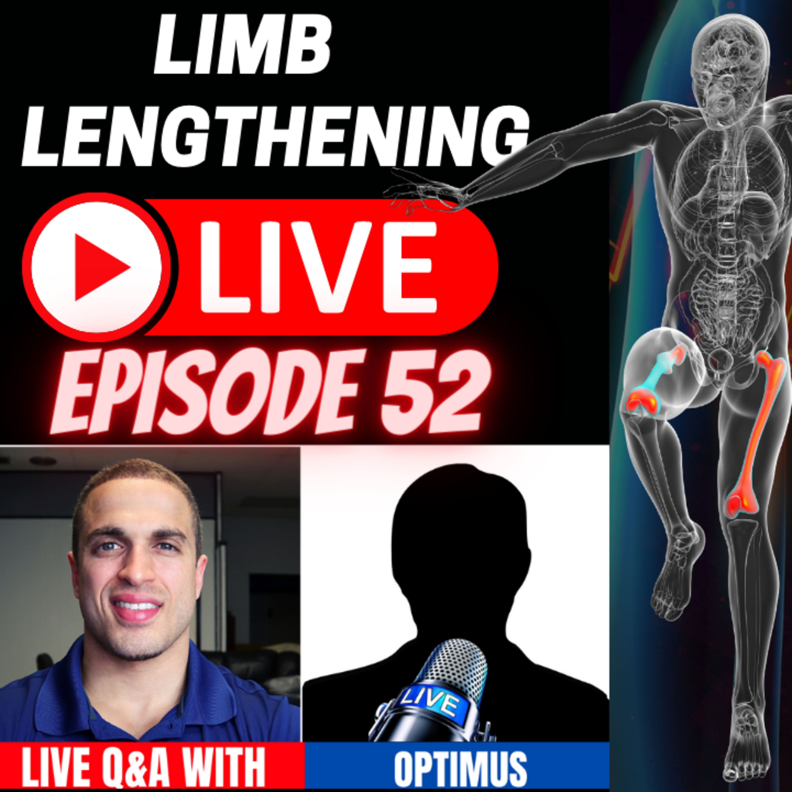 Limb Lengthening LIVE - Episode 52 -LIVE Q&A Update with LL Patient - Optimus