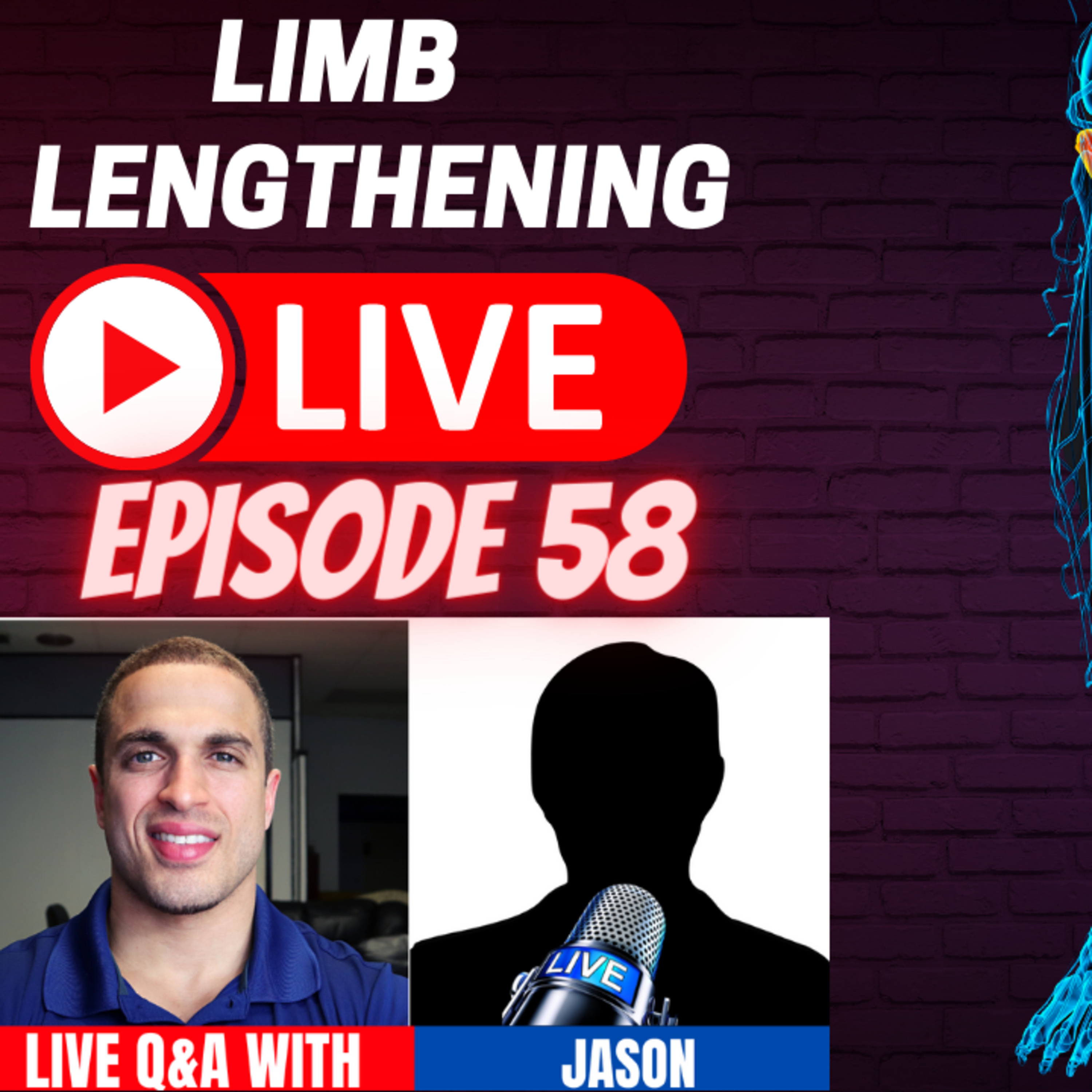 LL LIVE Ep. 58 - Limb Lengthening Patient 
