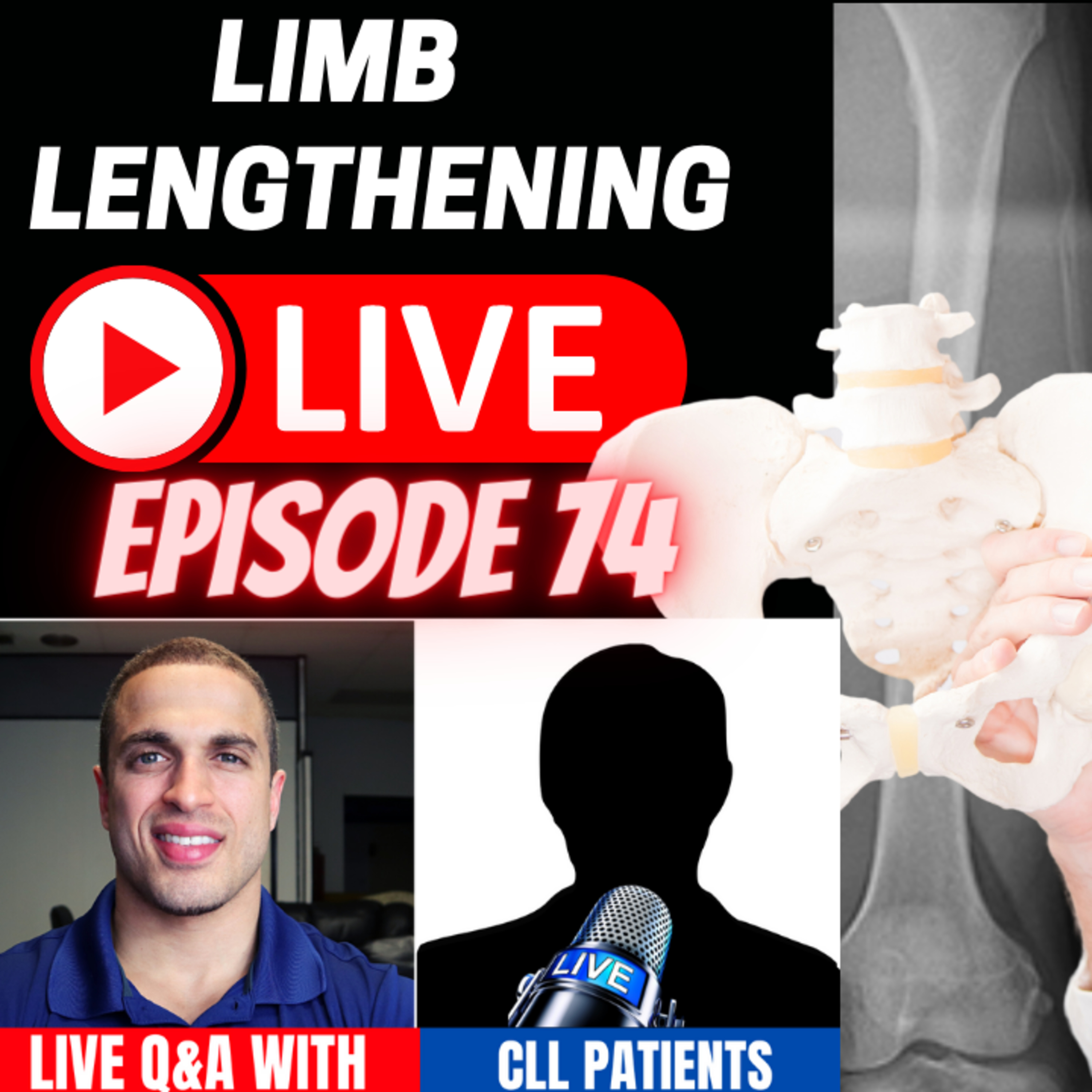 Limb Lengthening LIVE - Episode 74 - LIVE with Cosmetic Limb Lengthening (CLL) Patients