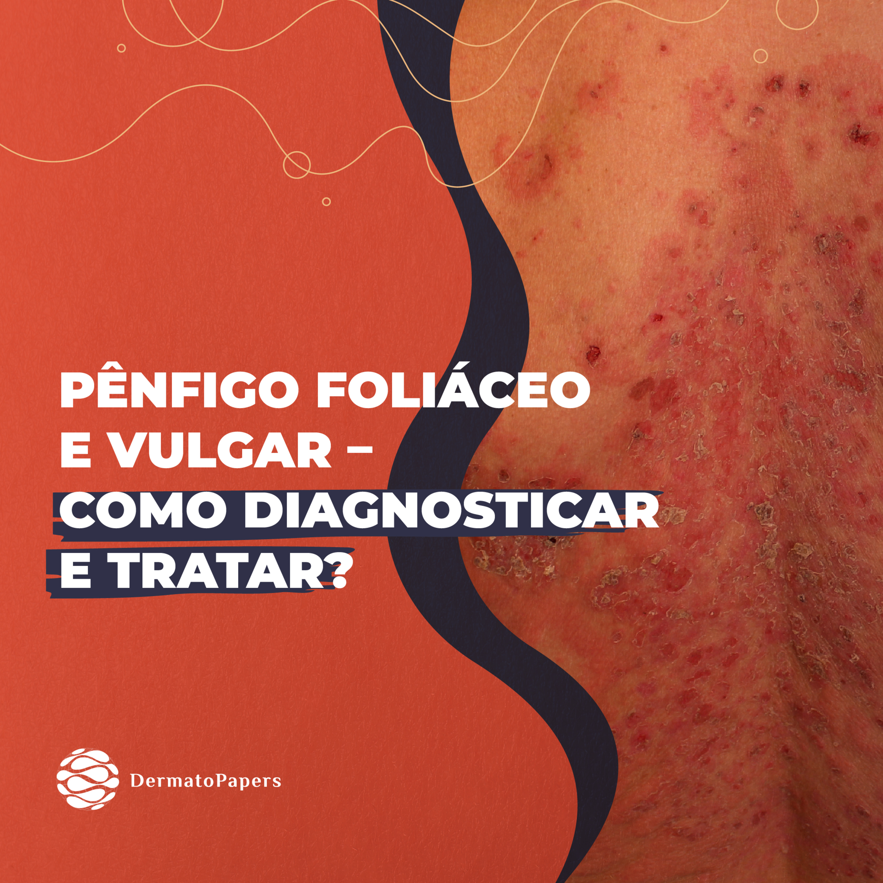 #142-PÊNFIGO FOLIÁCEO E VULGAR – COMO DIAGNOSTICAR E TRATAR  episode artwork