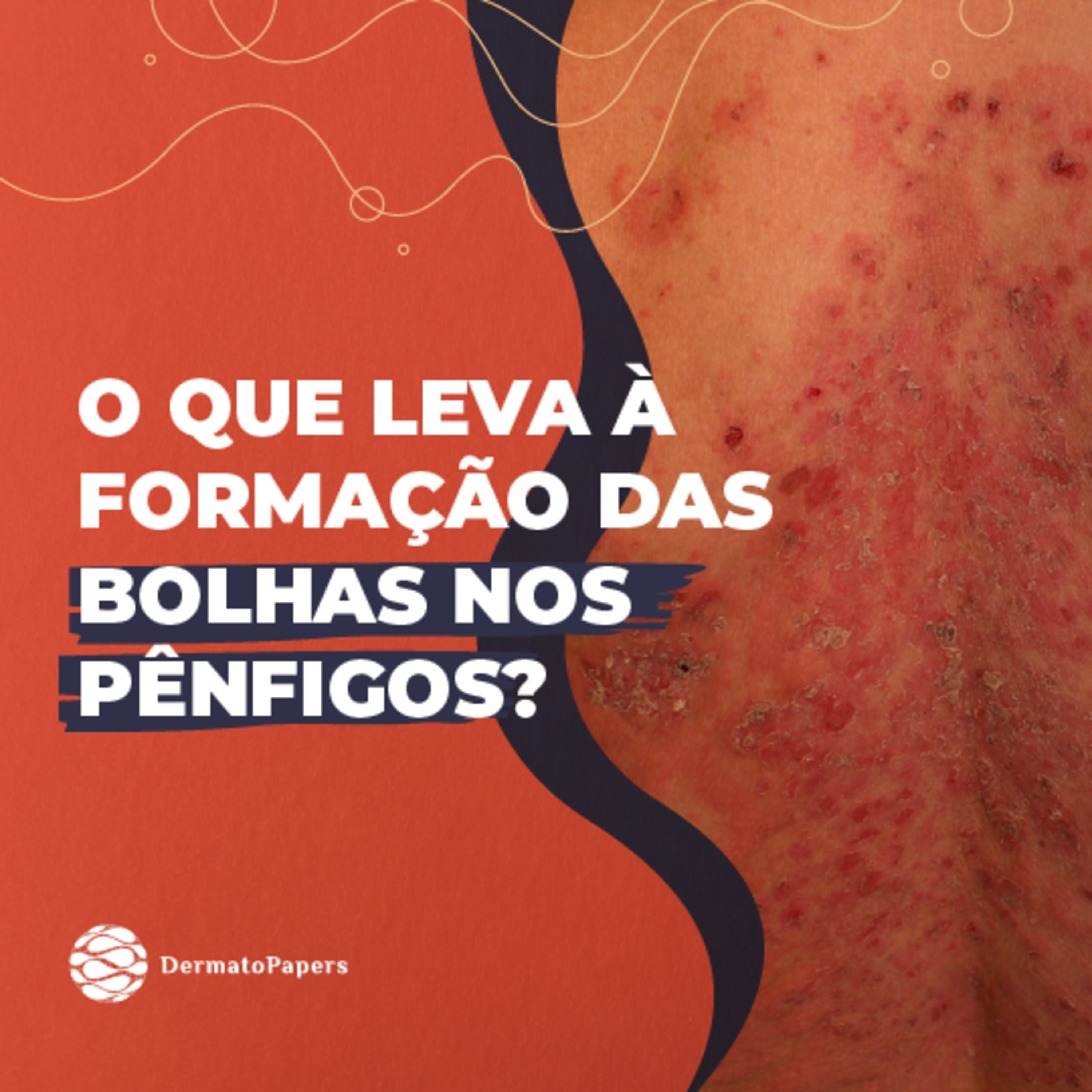 #144-O que leva à formação das bolhas nos pênfigos? episode artwork