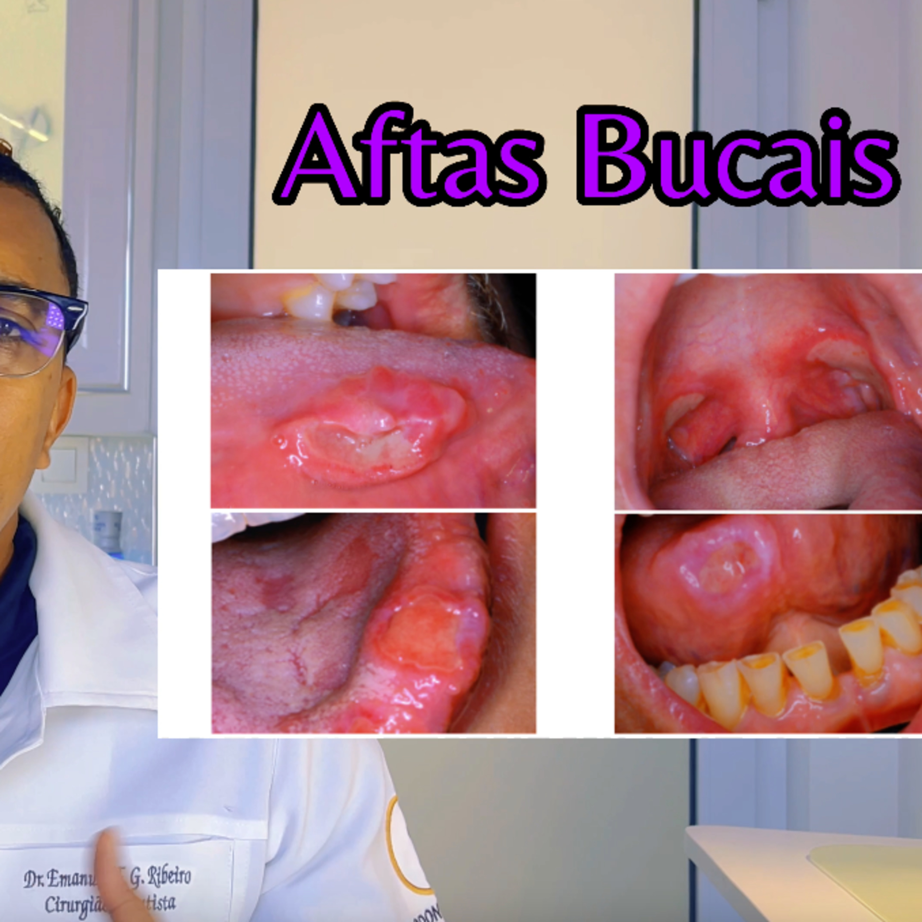 Aftas Bucais episode artwork