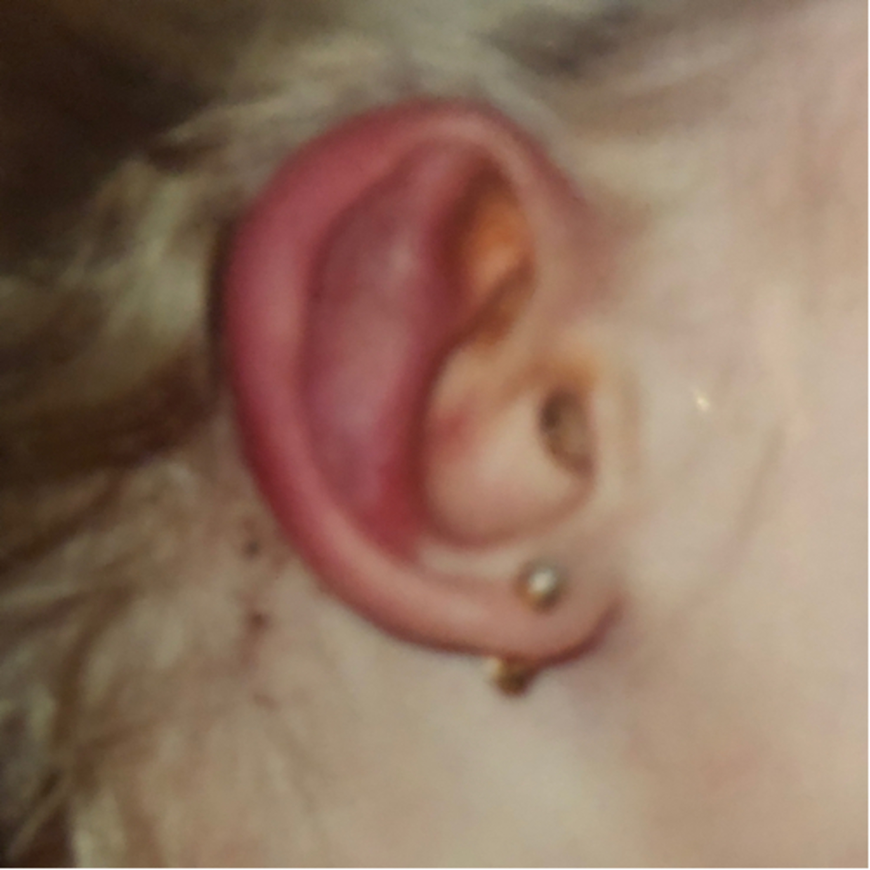 A mom\'s journey with 22q11.2